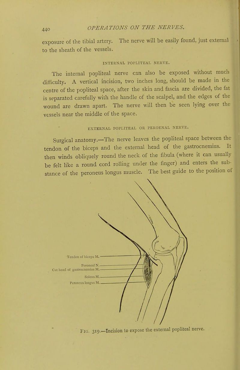 exposure of the tibial artery. The nerve will be easily found, just external to the sheath of the vessels. INTERNAL POPLITEAL NERVE. The internal popliteal nerve can also be exposed without much difficulty. A vertical incision, two inches long, should be made in the centre of the popliteal space, after the skin and fascia are divided, the fat is separated carefully with the handle of the scalpel, and the edges of the wound are drawn apart. The nerve will then be seen lying over the vessels near the middle of the space. EXTERNAL POPLITEAL OR PEROENAL NERVE. Surgical anatomy.—The nerve leaves the popliteal space between the tendon of the biceps and the external head of the gastrocnemius. It then winds obliquely round the neck of the fibula (where it can usually be felt like a round cord rolling under the finger) and enters the sub- stance of the peroneus longus muscle. The best guide to the position of Tendon of biceps M. Peroneal N, Cut head of gastrocnemius M Soleus M Peroneus longus M Fir.. 319.—Incision to expose the external popliteal ner\-e.