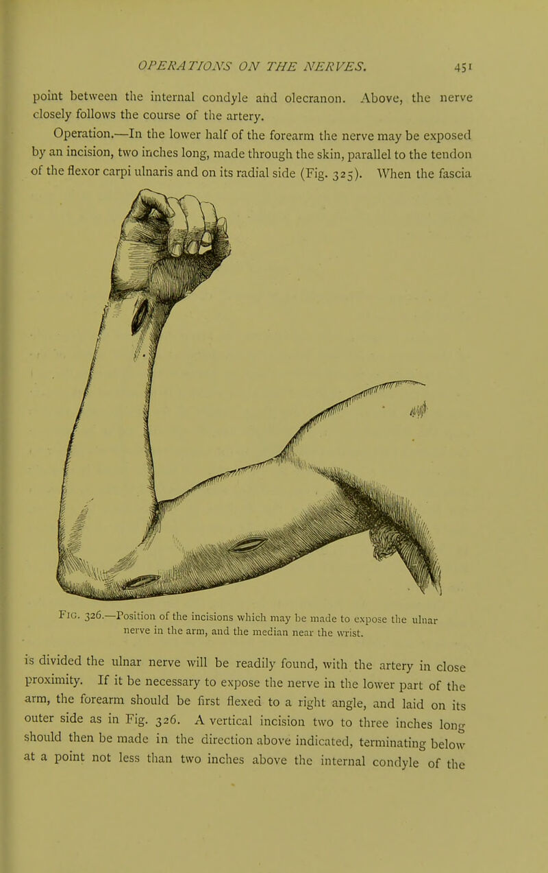 point between the internal condyle arid olecranon. Above, the nerve closely follows the course of the artery. Operation.—In the lower half of the forearm the nerve may be exposed by an incision, two inches long, made through the skin, parallel to the tendon of the flexor carpi ulnaris and on its radial side (Fig. 325). When the fascia • 326.—rosition of the incisions which may be made to expose the uhiar nerve in the arm, and the median near the wi-ist. is divided the ulnar nerve will be readily found, with the artery in close proximity. If it be necessary to expose the nerve in the lower part of the arm, the forearm should be first flexed to a right angle, and laid on its outer side as in Fig. 326. A vertical incision two to three inches long should then be made in the direction above indicated, terminating below at a point not less than two inches above the internal condyle of the
