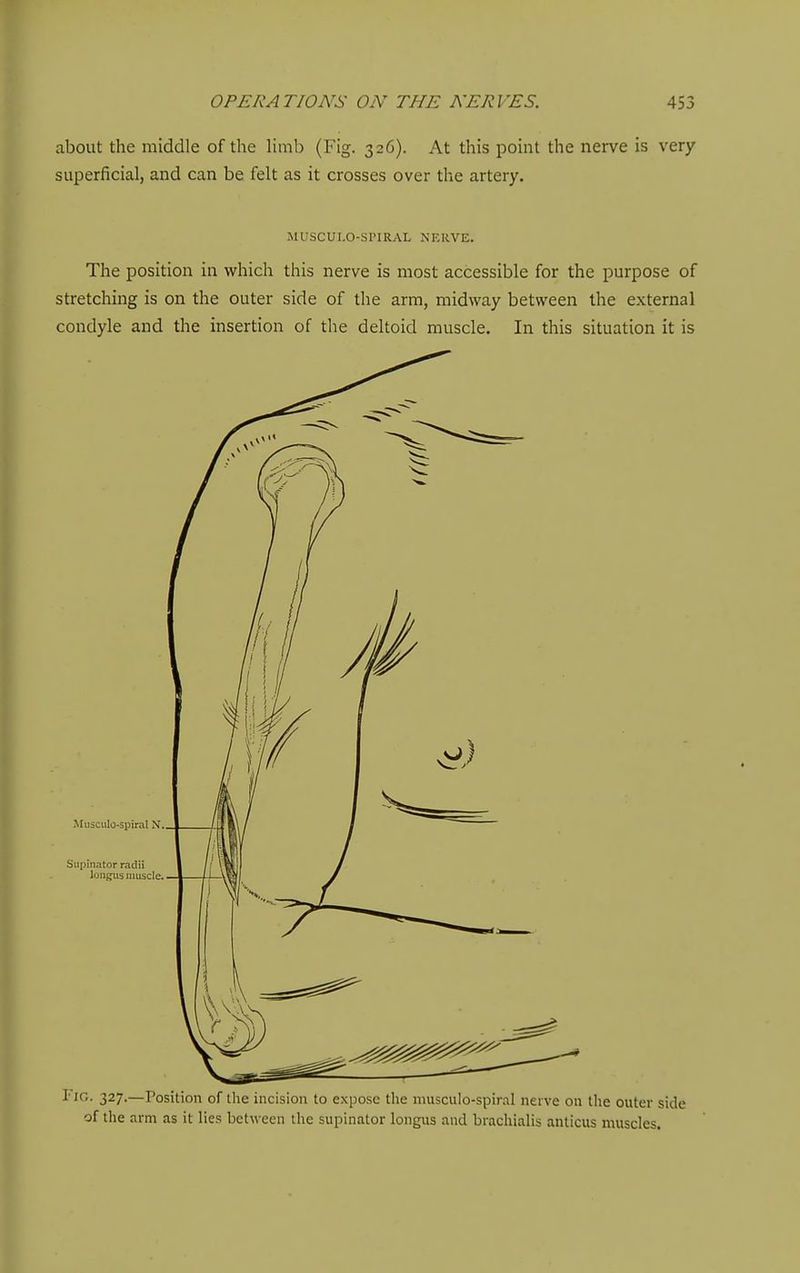 about the middle of the limb (Fig. 326). At this point the nerve is very superficial, and can be felt as it crosses over the artery. MUSCUI.O-SPIRAL NERVE. The position in which this nerve is most accessible for the purpose of stretching is on the outer side of the arm, midway between the external condyle and the insertion of the deltoid muscle. In this situation it is Musciilo-spiral N., Supinator radii luiiKiis muscle. Fjg. 327.—Position of the incision to expose tlie musculo-spiral nerve on the outer side of tlie arm as it lies between the supinator longus and brachialis anticus muscles.