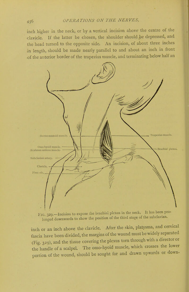 inch higher in the neck, or by a vertical incision above the centre of the clavicle. If the latter be chosen, the shoulder should be depressed, and the head turned to the opposite side. An incision, of about three inches ,in length, should be made nearly parallel to and about an inch in front of the anterior border of the trapezius muscle, and terminating below half an Fig' 329.-Incisioii to expose ihe brachial plexus in the neck. It has been pro- longed downwards to show the position of the third stage of the subclavian. inch or an inch above the clavicle. After the skin, platysma, and cervical fascia have been divided, the margins of the wound must be widely separated (Fig. 329), and the tissue covering the plexus torn through with a director or the handle of a scalpel. The omo-hyoid muscle, which crosses the lower portion of the wound, shotild be sought for and drawn upwards or down-