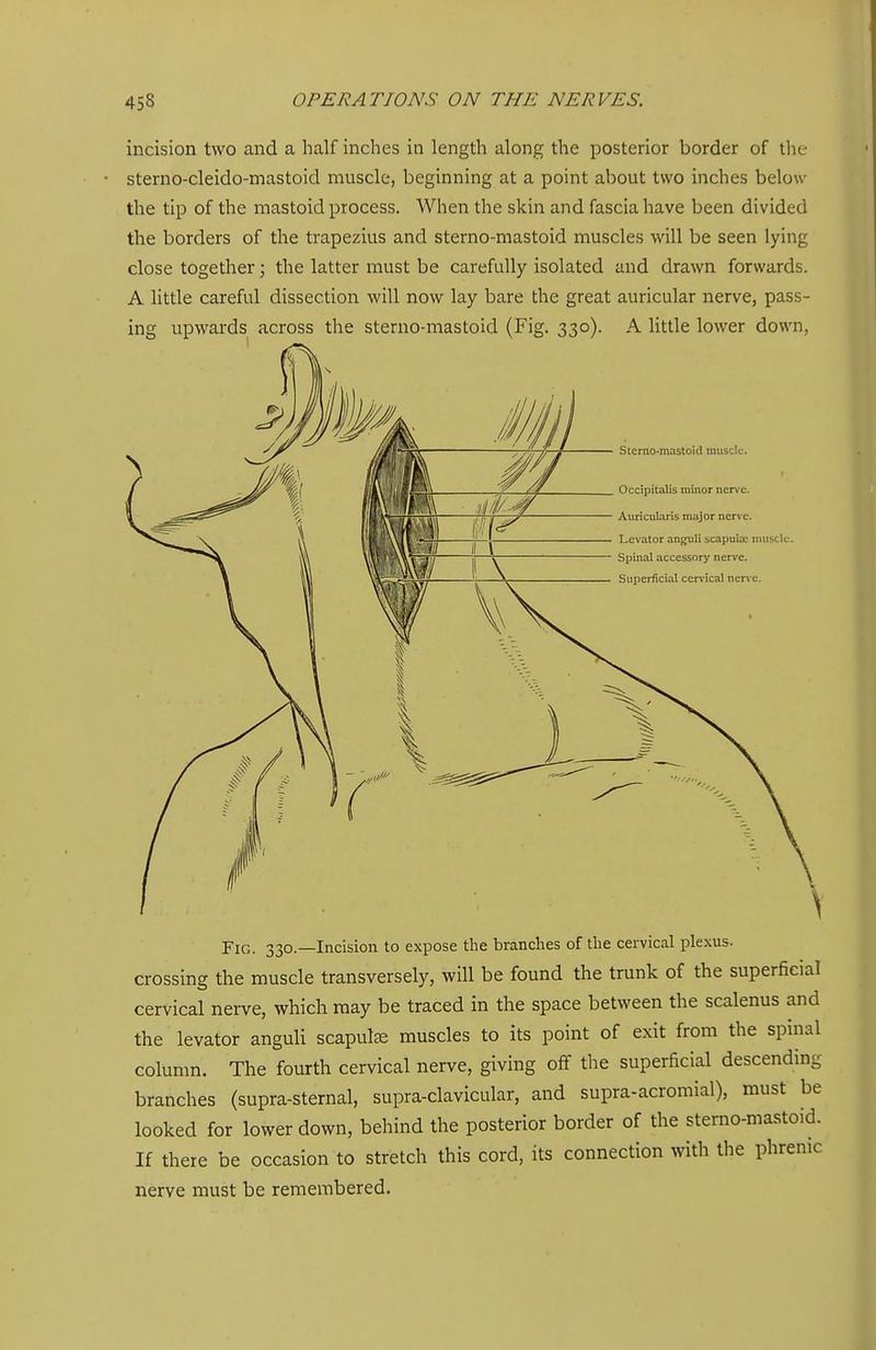 incision two and a half inches in length along the posterior border of the sterno-cleido-mastoid muscle, beginning at a point about two inches below the tip of the mastoid process. When the skin and fascia have been divided the borders of the trapezius and sterno-mastoid muscles will be seen lying close together; the latter must be carefully isolated and drawn forwards. A little careful dissection will now lay bare the great auricular nerve, pass- ing upwards across the sterno-mastoid (Fig. 330). A little lower down, Sterno-mastoid muscle. Occipitalis minor ner\*e. Auricularis major nerve. Levator anguli scapuUc muscle. Spinal accessory nerve. Superficial cervical nerie. Fig. 330.—Incision to expose the branches of the cervical plexus, crossing the muscle transversely, will be found the trunk of the superficial cervical nerve, which may be traced in the space between the scalenus and the levator anguli scapute muscles to its point of exit from the spinal column. The fourth cervical nerve, giving off the superficial descending branches (supra-sternal, supra-clavicular, and supra-acromial), must be looked for lower down, behind the posterior border of the sterno-mastoid. If there be occasion to stretch this cord, its connection with the phrenic nerve must be remembered.
