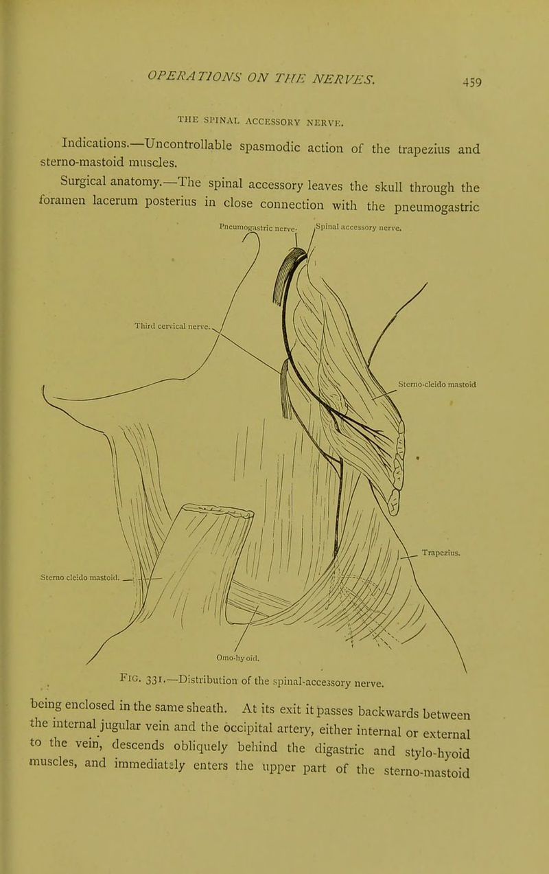 459 THE Sl'INAI. ACCESSORY NERVK. Indications.—Uncontrollable spasmodic action of the trapezius and sterno-mastoid muscles. Surgical anatomy.—The spinal accessory leaves the skull through the foramen lacerum posterius in close connection with the pneumogastric PncuinoKTistric nerve- /Spinal accessory nerve. 1 Sterno-deido mastoid Omo-Iiy Old. Fig. 331.—Distribution of the spinal-accessory nerve. being enclosed in the same sheath. At its exit it passes backwards between the mternal jugular vein and the occipital artery, either internal or external to the vein, descends obliquely behind the digastric and stylo-hyoid muscles, and immediately enters the upper part of the sterno-mastoid