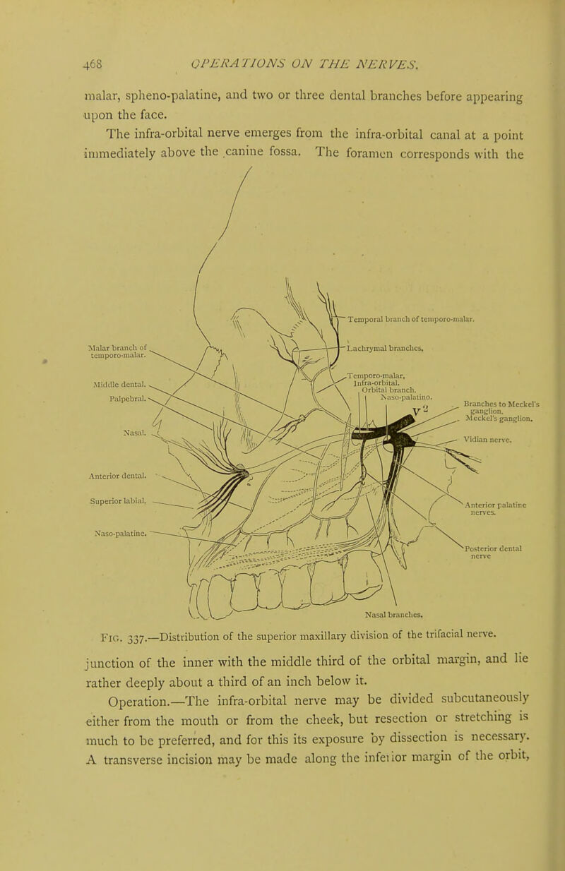 malar, spheno-palatine, and two or three dental branches before appearing upon the face. The infra-orbital nerve emerges from the infra-orbital canal at a point inmiediately above the canine fossa. The foramen corresponds with the Temporal branch of teuiporo-nialar. ■Malar branch of teniporo-nialiir. Middle dental. Palpebral. Nasal. Anterior dental. Superior labial. Naso-palatine. Branches to Meckel's jjant'lion. Meckel's ganglion. Vidian nerve. .•\nterior palatine ner\'es. Posterior dental ner^•e Nasal branches. Fig. 337.—Distribution of the superior maxillary division of the trifacial nerve. junction of the inner with the middle third of the orbital margin, and lie rather deeply about a third of an inch below it. Operation.—The infra-orbital nerve may be divided subcutaneously either from the mouth or from the cheek, but resection or stretching is much to be preferred, and for this its exposure by dissection is necessary. A transverse incision may be made along the infeiior margin of the orbit,