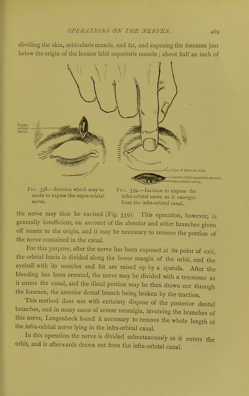 dividing die skin, orbicularis muscle, and fat, and exposing the foramen just below the origin of the levator labii superioris muscle ; about half an inch of Supra- ^ orbital ^ uer\'e. ■ Line of floor of orbit. ■Levator labii superioris muscle. •Infra-orbita! nerve. Fig. 338.—Incision which may be made to expose the supra-orbital nerve. 339.—Incision to expose the infra-orbital nerve as it emerges from the infra-orbital canal. the nerve may thus be excised (Fig. 339). This operation, however, is generally insufficient, on account of the alveolar and other branches given off nearer to the origin, and it may be necessary to remove the portion of the nerve contained in the canal. For this purpose, after the nerve has been exposed at its point of exit the orbital fascia is divided along the lower margin of the orbit, and the eyeball with its muscles and fat are raised up by a spatula. After the bleeding has been arrested, the nerve may be divided with a tenotome as it enters the canal, and the distal portion may be then drawn out through the foramen, the anterior dental branch being broken by the traction. This method does not with certainty dispose of the posterior dental branches, and in many cases of severe neuralgia, involving the branches of this nerve, Langenbeck found it necessary to remove the whole length of the .infra-orbital nerve lying in the infra-orbital canal. In this operation the nerve is divided subcutaneously as it enters the orbit, and is afterwards drawn out from the infra-orbital canal.