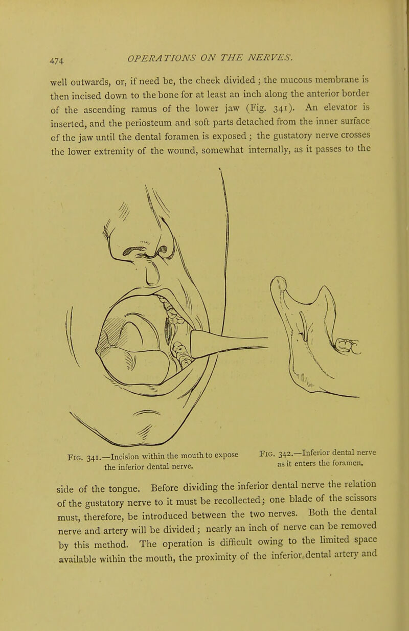 well outwards, or, if need be, the cheek divided ; the mucous membrane is then incised down to the bone for at least an inch along the anterior border of the ascending ramus of the lower jaw (Fig. 341). An elevator is inserted, and the periosteum and soft parts detached from the inner surface of the jaw until the dental foramen is exposed ; the gustatory nerve crosses the lower extremity of the wound, somewhat internally, as it passes to the Fig. 341.—Incision within the mouth to expose the inferior dental nerve. Fig. 342.—Inferior dental nerve as it enters the foramen. side of the tongue. Before dividing the inferior dental nerve the relation of the gustatory nerve to it must be recollected; one blade of the scissors must, therefore, be introduced between the two nerves. Both the deutal nerve and artery will be divided; nearly an inch of nerve can be removed by this method. The operation is difficult owing to the limited space available within the mouth, the proximity of the inferior dental artery and