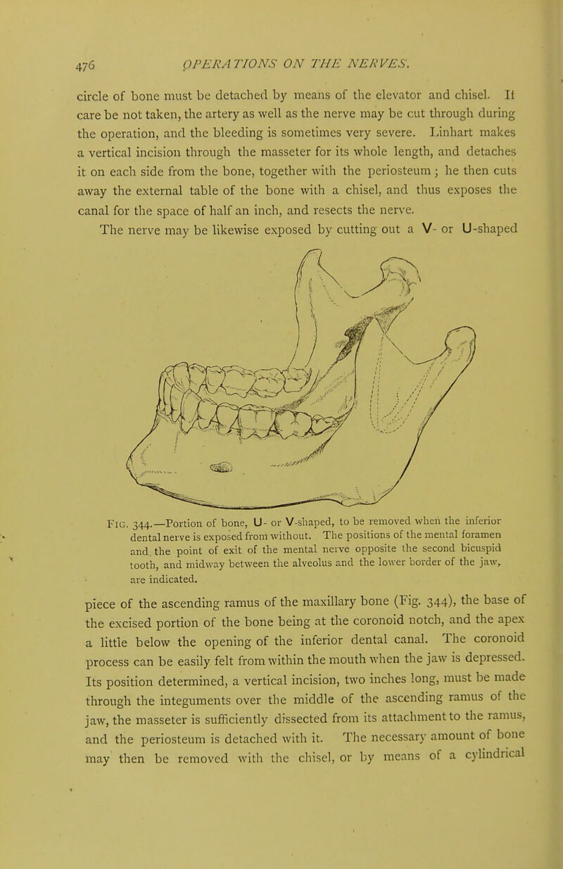 circle of bone must be detached by means of the elevator and chisel. It care be not taken, the artery as well as the nerve may be cut through during the operation, and the bleeding is sometimes very severe. Linhart makes a vertical incision through the masseter for its whole length, and detaches it on each side from the bone, together with the periosteum; he then cuts away the external table of the bone with a chisel, and thus exposes the canal for the space of half an inch, and resects the nerve. The nerve may be likewise exposed by cutting out a V- or U-shaped Fig. 344.—Portion of bone, U- or V-shaped, to be removed when the inferior dental nerve is exposed from without. The positions of the mental foramen and. the point of exit of the mental nerve opposite ihe second bicuspid tooth, and midway between the alveolus and the lower border of the jaw, are indicated. piece of the ascending ramus of the maxillary bone (Fig. 344), the base of the excised portion of the bone being at the coronoid notch, and the apex a little below the opening of the inferior dental canal. The coronoid process can be easily felt from within the mouth when the jaw is depressed- Its position determined, a vertical incision, two inches long, must be made through the integuments over the middle of the ascending ramus of the jaw, the masseter is sufficiently dissected from its attachment to the ramus, and the periosteum is detached with it. The necessary amount of bone may then be removed with the chisel, or by means of a cylindrical