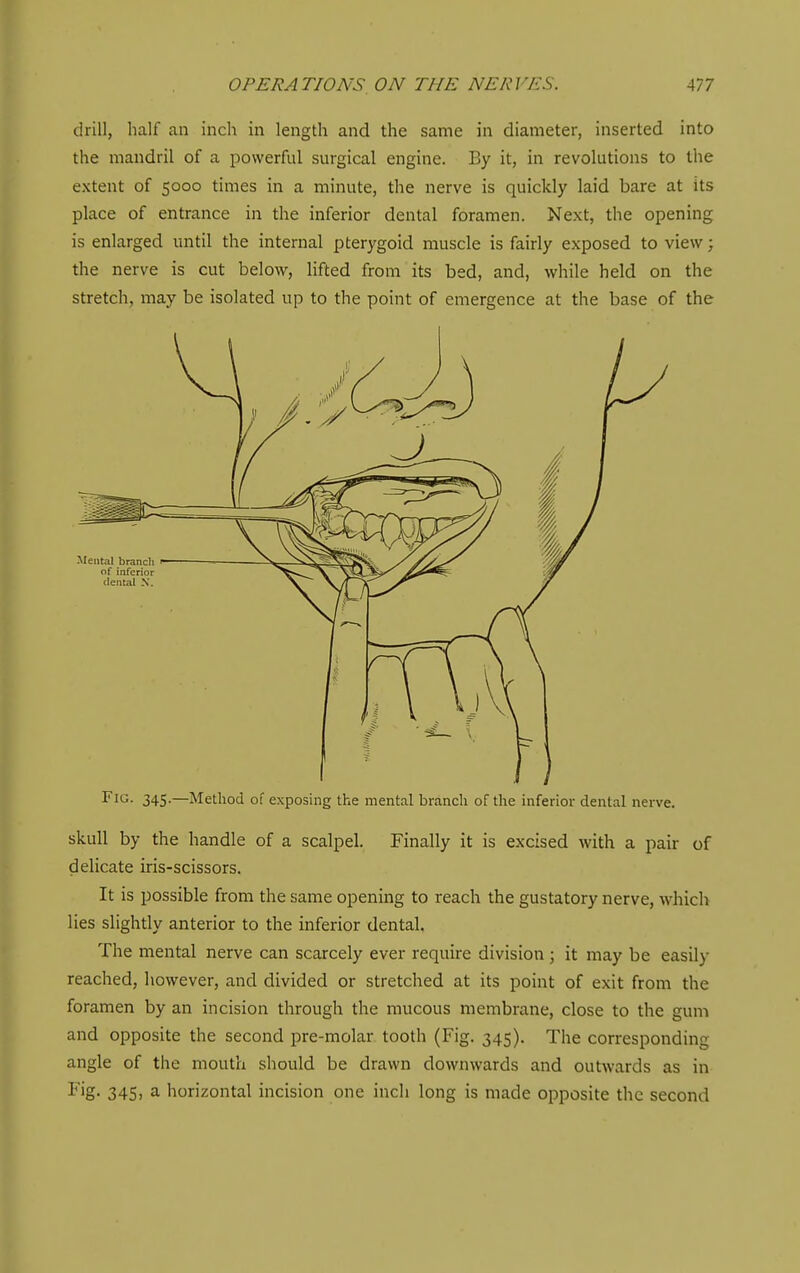 drill, half an inch in length and the same in diameter, inserted into the mandril of a iiovverful surgical engine. By it, in revolutions to the extent of 5000 times in a minute, the nerve is quickly laid bare at its place of entrance in the inferior dental foramen. Next, the opening is enlarged until the internal pterygoid muscle is fairly exposed to view; the nerve is cut below, lifted from its bed, and, while held on the stretch, may be isolated up to the point of emergence at the base of the Fio- 345-—Method of exposing the mental branch of the inferior dental nerve. skull by the handle of a scalpel. Finally it is excised with a pair of delicate iris-scissors. It is possible from the same opening to reach the gustatory nerve, which lies slightly anterior to the inferior dental. The mental nerve can scarcely ever require division ; it may be easily reached, however, and divided or stretched at its point of exit from the foramen by an incision through the mucous membrane, close to the gum and opposite the second pre-molar tooth (Fig. 345). The corresponding angle of the mouth should be drawn downwards and outwards as in Fig. 345> 3- horizontal incision one inch long is made opposite the second