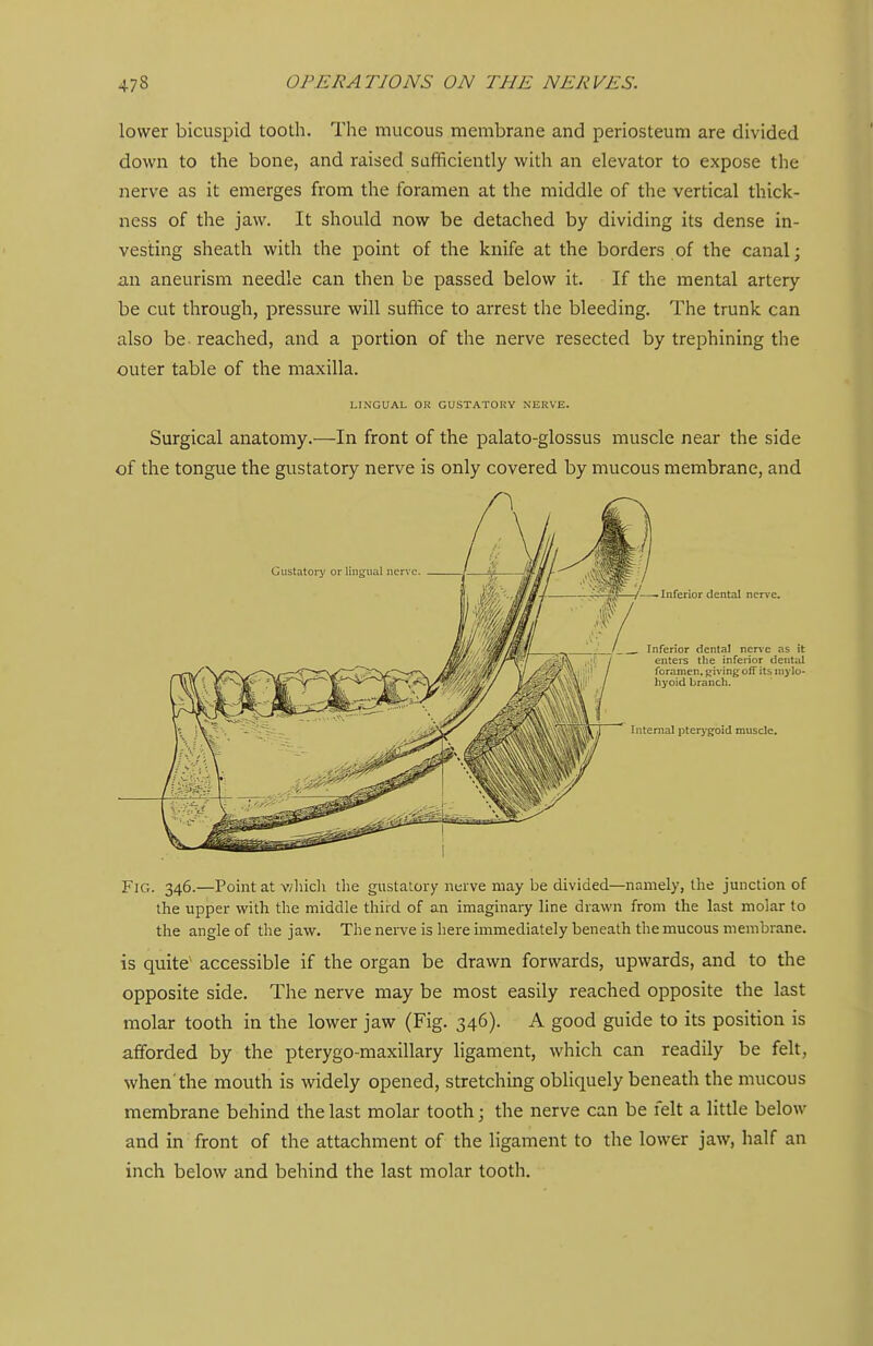 lower bicuspid tooth. The mucous membrane and periosteum are divided down to the bone, and raised safiiciently with an elevator to expose the nerve as it emerges from the foramen at the middle of the vertical thick- ness of the jaw. It should now be detached by dividing its dense in- vesting sheath with the point of the knife at the borders of the canal; an aneurism needle can then be passed below it. If the mental artery be cut through, pressure will suffice to arrest the bleeding. The trunk can also be reached, and a portion of the nerve resected by trephining the outer table of the maxilla. LINGUAL OR GUSTATORY NERVE. Surgical anatomy.—In front of the palato-glossus muscle near the side of the tongue the gustatory nerve is only covered by mucous membrane, and Fig. 346.—Point at v/liicli the gustatoi-y nerve may be divided—namely, the junction of the upper with the middle third of an imaginary line drawn from the last molar to the angle of the jaw. The nerve is here immediately beneath the mucous membrane. is quite' accessible if the organ be drawn forwards, upwards, and to the opposite side. The nerve may be most easily reached opposite the last molar tooth in the lower jaw (Fig. 346). A good guide to its position is afforded by the pterygo-maxillary ligament, which can readily be felt, when'the mouth is widely opened, stretching obliquely beneath the mucous membrane behind the last molar tooth; the nerve can be felt a little below and in front of the attachment of the ligament to the lower jaw, half an inch below and behind the last molar tooth.