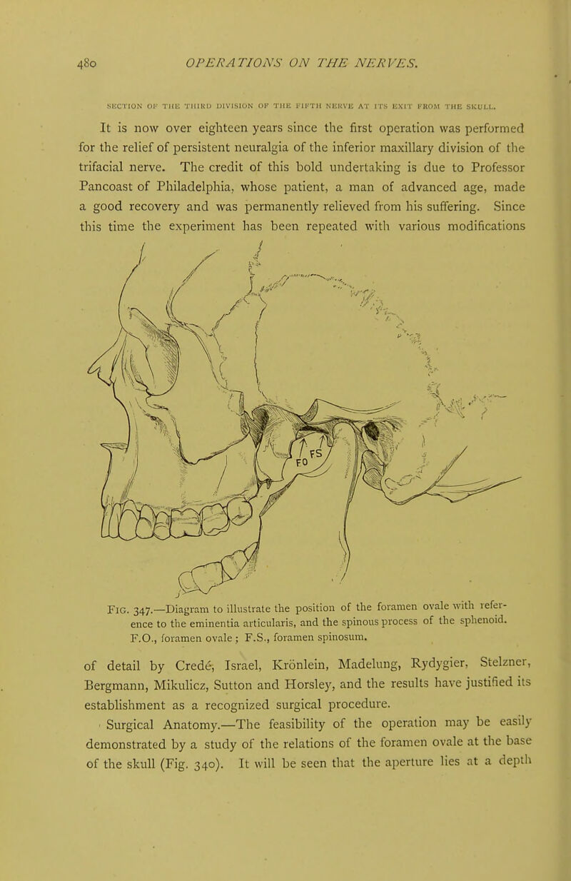 SECTION OI'- THE TlllKU DIVISION OK THE IfllrH NKKVE AT ITS EXIT FROM THE SICULI,. It is now over eighteen years since the first operation was performed for the relief of persistent neuralgia of the inferior maxillary division of the trifacial nerve. The credit of this bold undertaking is due to Professor Pancoast of Philadelphia, whose patient, a man of advanced age, made a good recovery and was permanently relieved from his suffering. Since this time the experiment has been repeated with various modifications Fig. 347.—Diagram to illustrate the position of the foramen ovale with refer- ence to the eminentia articularis, and the spinous process of the sphenoid. F.O., foramen ovale ; F.S., foramen spinosum. of detail by Crede, Israel, Kronlein, Madelung, Rydygler, Stelzner, Bergmann, MikuHcz, Sutton and Horsley, and the results have justified its establishment as a recognized surgical procedure. Surgical Anatomy.—The feasibility of the operation may be easily demonstrated by a study of the relations of the foramen ovale at the base of the skull (Fig. 340). It will be seen that the aperture lies at a deptli