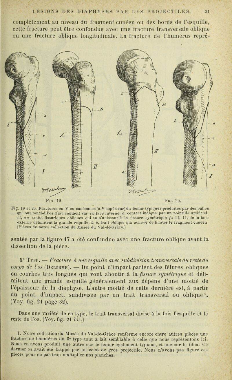 complètement au niveau du fragment cunéen ou des bords de l’esquille, cette fracture peut être confondue avec une fracture transversale oblique ou une fracture oblique longitudinale. La fracture de l’humérus repré- Fig. 19. Fig. 20. Fig. 19 et 20. Fractures en V ou cunéennes (à V supérieur) du fémur typiques produites par des balles qui ont touché l’os (fait contact) sur sa face interne, c, contact indiqué par un pointillé artificiel. II, a a traits fissuriques obliques qui en s’unissant à la fissure symétrique fs II, II, de la face externe délimitent la grande esquille, b, b, trait oblique qui achève de limiter le fragment cunéen. (Pièces de notre collection du Musée du Val-de-Grâce.) sentée par la figure 17 a été confondue avec une fracture oblique avant la dissection de la pièce. 5e Type. —- Fracture à une esquille avec subdivision transversale du reste du corps de l’os (Delorme). •— Du point d’impact partent des fêlures obliques en courbes très longues qui vont aboutir à la fissure symétrique et déli¬ mitent une grande esquille généralement aux dépens d’une moitié de l’épaisseur de la diaphyse. L’autre moitié de cette dernière est, à partir du point d’impact, subdivisée par un trait transversal ou obliquei. (Yoy. fig. 21 page 32). Dans une variété de ce type, le trait transversal divise à la fois l’esquille et le reste de l’os. (Voy. fig. 21 bis.) 1. Notre collection du Musée du Val-de-G-râce renferme encore entre autres pièces une fracture de l’humérus du Se type tout à fait semblable à celle que nous représentons ici. Nous en avons produit une autre sur le fémur également typique, et une sur le tibia. Ce dernier os avait été frappé par un éclat de gros projectile. Nous n’avons pas figuré ces pièces pour ne pas trop multiplier nos planches.