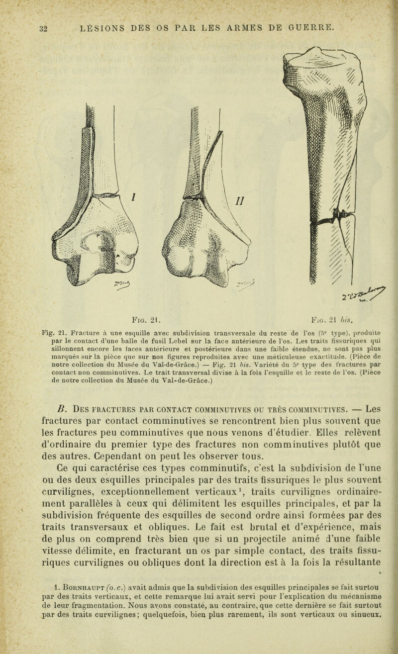 Fig. 21. Fig. 21 bis. Fig. 21. Fracture à une esquille avec subdivision transversale du reste de l’os (5e type), produite par le contact d’une balle de fusil Lebel sur la face antérieure de l’os. Les traits fissuriques qui sillonnent encore les faces antérieure et postérieure dans une faible étendue, ne sont pas plus marqués sur la pièce que sur nos figures reproduites avec une méticuleuse exactitude. (Pièce de notre collection du Musée du Val-de-Grâce.) — Fig. 21 bis. Variété du 5e type des fractures par contact non comminutives. Le trait transversal divise à la fois l’esquille et le reste de l’os. (Pièce de notre collection du Musée du Val-de-Grâce.) B. Des fractures par contact comminutives ou très comminutives. — Les fractures par contact comminutives se rencontrent bien plus souvent que les fractures peu comminutives que nous venons d’étudier. Elles relèvent d’ordinaire du premier type des fractures non comminutives plutôt que des autres. Cependant on peut les observer tous. Ce qui caractérise ces types comminutifs, c’est la subdivision de l’une ou des deux esquilles principales par des traits fissuriques le plus souvent curvilignes, exceptionnellement verticaux1, traits curvilignes ordinaire¬ ment parallèles à ceux qui délimitent les esquilles principales, et par la subdivision fréquente des esquilles de second ordre ainsi formées par des traits transversaux et obliques. Le fait est brutal et d’expérience, mais de plus on comprend très bien que si un projectile animé d’une faible vitesse délimite, en fracturant un os par simple contact, des traits fissu¬ riques curvilignes ou obliques dont la direction est à la fois la résultante 1. Bornhaupt (o.c.) avait admis que la subdivision des esquilles principales se fait surtou par des traits verticaux, et cette remarque lui avait servi pour l’explication du mécanisme de leur fragmentation. Nous avons constaté, au contraire, que cette dernière se fait surtout par des traits curvilignes ; quelquefois, bien plus rarement, ils sont verticaux ou sinueux.