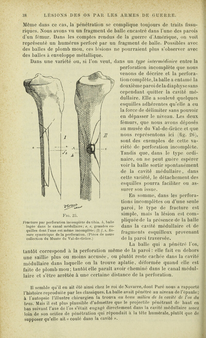 Même dans ce cas, la pénétration se complique toujours de traits fissu- riques. Nous avons vu un fragment de balle encastré dans l’une des parois d’un fémur. Dans les comptes rendus de la guerre d’Amérique, on voit représenté un humérus perforé par un fragment de balle. Possibles avec des balles de plomb mou, ces lésions ne pourraient plus s’observer avec des balles à enveloppe métallique. Dans une variété ou, si l’on veut, dans un type intermédiaire entre la perforation incomplète que nous venons de décrire et la perfora¬ tion complète, la balle a entamé la deuxième paroi de la diaphyse sans cependant quitter la cavité mé¬ dullaire. Elle a soulevé quelques esquilles adhérentes qu’elle a eu la force de délimiter sans pouvoir en dépasser le niveau. Les deux fémurs, que nous avons déposés au musée du Val-de-Grâce et que nous représentons ici (fig. 26), sont des exemples de cette va¬ riété de perforation incomplète. Tandis que, dans le type ordi¬ naire, on ne peut guère espérer voir la balle sortir spontanément de la cavité médullaire, dans cette variété, le détachement des esquilles pourra faciliter ou as¬ surer son issue. En somme, dans les perfora¬ tions incomplètes ou d’une seule paroi, le type de fracture est simple, mais la lésion est com¬ pliquée de la présence de la balle dans la cavité médullaire et de fragments esquilleux provenant de la paroi traversée. La balle qui a pénétré l’os, tantôt correspond à la perforation même de la paroi : elle fait en dehors une saillie plus ou moins accusée, ou plutôt reste cachée dans la cavité médullaire dans laquelle on la trouve aplatie, déformée quand elle est faite de plomb mou; tantôt elle paraît avoir cheminé dans le canal médul¬ laire et s’être arrêtée à une certaine distance de la perforation. Fig. 2o. Fracture par perforation incomplète du tibia, b, balle logée dans le canal médullaire ; e, e, grandes es¬ quilles dont l’une est même incomplète; (I) /, s, fis¬ sure symétrique de la perforation. (Pièce de notre collection du Musée du Val-de-Grâce.) Il semble qu’il en ait été ainsi chez le roi de Navarre, dont Paré nous a rapporté Thistoire reproduite par les classiques. La balle avait pénétré au niveau de l’épaule ; à l’autopsie l’illustre chirurgien la trouva au beau milieu de la cavité de l’os du bras. Mais il est plus plausible d’admettre que le projectile pénétrant de haut en bas suivant l’axe de l’os s’était engagé directement dans la cavité médullaire assez loin de son orifice de pénétration qui répondait à la tête humérale, plutôt que de supposer qu’elle ait « coulé dans la cavité ».