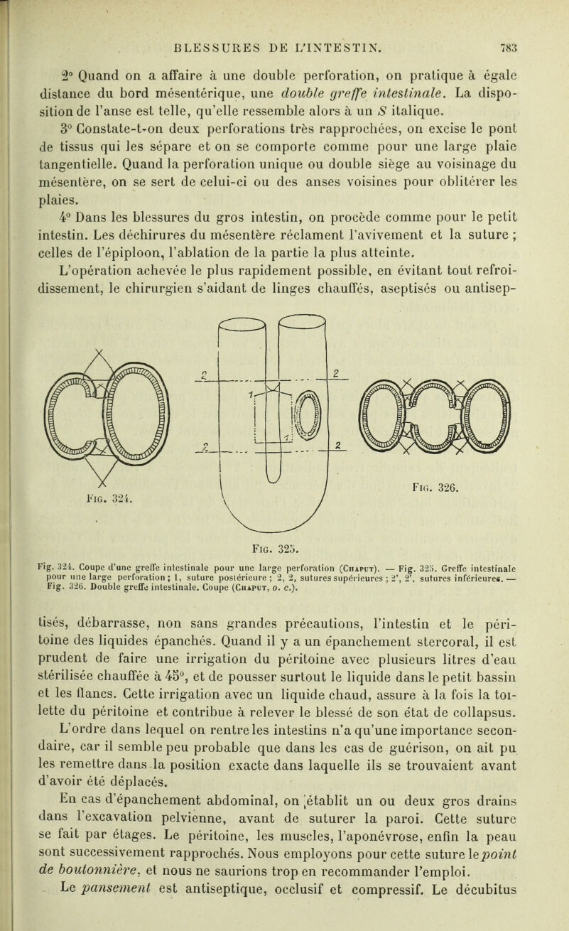 2° Quand on a affaire à une double perforation, on pratique à égale distance du bord mésentérique, une double greffe intestinale. La dispo¬ sition de l’anse est telle, qu’elle ressemble alors à un S italique. 3° Constate-t-on deux perforations très rapprochées, on excise le pont de tissus qui les sépare et on se comporte comme pour une large plaie tangentielle. Quand la perforation unique ou double siège au voisinage du mésentère, on se sert de celui-ci ou des anses voisines pour oblitérer les plaies. 4° Dans les blessures du gros intestin, on procède comme pour le petit intestin. Les déchirures du mésentère réclament l’avivement et la suture ; celles de l’épiploon, l’ablation de la partie la plus atteinte. L’opération achevée le plus rapidement possible, en évitant tout refroi¬ dissement, le chirurgien s’aidant de linges chauffés, aseptisés ou antisep- Fig. 325. Fig. 324. Coupe d’une greffe intestinale pour une large perforation (Chaput). — Fig. 325. Greffe intestinale pour une large perforation; 1, suture postérieure ; 2, 2, sutures supérieures ; 2’, 2’, sutures inférieures. — Fig. 326. Double greffe intestinale. Coupe (Chaput, o. c.). Usés, débarrasse, non sans grandes précautions, l’intestin et le péri¬ toine des liquides épanchés. Quand il y a un e'panchement stercoral, il est prudent de faire une irrigation du péritoine avec plusieurs litres d’eau stérilisée chauffée à 45°, et de pousser surtout le liquide dans le petit bassin et les flancs. Cette irrigation avec un liquide chaud, assure à la fois la toi¬ lette du péritoine et contribue à relever le blessé de son état de collapsus. L’ordre dans lequel on rentre les intestins n’a qu’une importance secon¬ daire, car il semble peu probable que dans les cas de guérison, on ait pu les remettre dans .la position exacte dans laquelle ils se trouvaient avant d’avoir été déplacés. En cas d’épanchement abdominal, on 'établit un ou deux gros drains dans l’excavation pelvienne, avant de suturer la paroi. Cette suture se fait par étages. Le péritoine, les muscles, l’aponévrose, enfin la peau sont successivement rapprochés. Nous employons pour cette suture 1 epoint de boutonnière, et nous ne saurions trop en recommander l’emploi. Le pansement est antiseptique, occlusif et compressif. Le décubitus