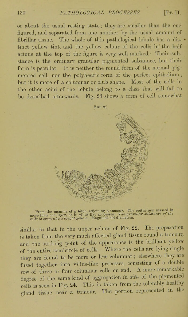 or about the usual resting state; they are smaller than the one figured, and separated from one another by the usual amount of fibrillar tissue. The whole of this pathological lobule has a dis- tinct yellow tint, and the yellow colour of the cells in the half acinus at the top of the figure is very well marked. Their sub- stance is the ordinary granular pigmented substance, but their form is peculiar. It is neither the round form of the normal pig- mented cell, nor the polyhedric form of the perfect epithelium; but it is more of a columnar or club shape. Most of the cells in the other acini of the lobule belong to a class that will fall to be described afterwards. Fig. 23 shows a form of cell somewhat Fig. 23. ■ From the mamma of a bitch, adjoining a tumour. The epithelium massptl in more than one layer, or in vilhis likc processes. The granular substance of the cells is everywhere bright yellow. Maguilied 300 diameters. similar to that in the upper acinus of Fig. 22. The preparation is taken from the very much affected gland tissue round a tumour, and the striking point of the appearance is the brilliant yellow of the entire semicircle of cells. Where the cells are lying single they are found to be more or less columnar ; elsewhere they are fused together into villus-like processes, consisting of a double row of three or four columnar cells on end. A more remarkable deo-ree of the same kind of aggregation in situ of the pigmented cells is seen in Fig. 24. This is taken from the tolerably healthy gland tissue near a tumour. The portion represented ni the