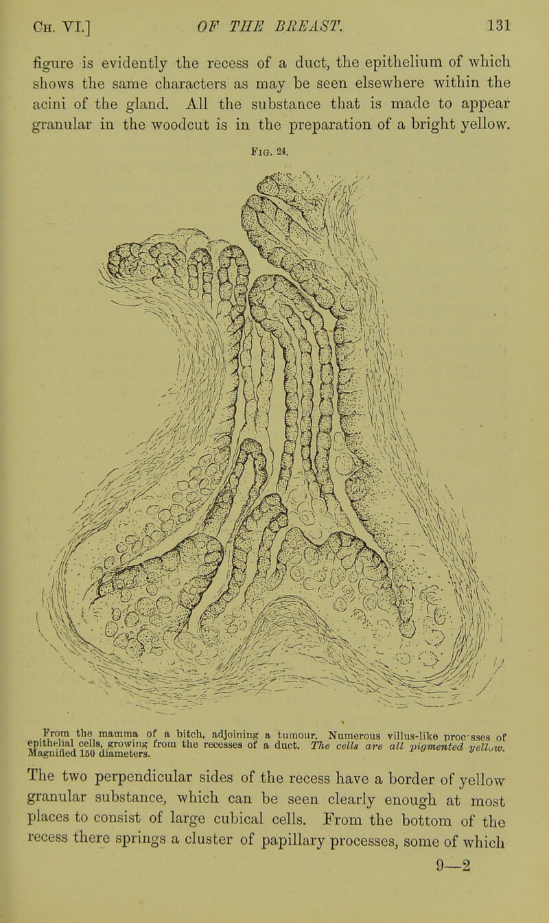 figure is evidently the recess of a duct, the epithelium of which shows the same characters as may be seen elsewhere within the acini of the gland. All the substance that is made to appear granular in the woodcut is in the preparation of a bright yellow. Fig. 24. From the mamma of a bitch, adjoining a tumour. Numerous villus-like procsses of epithelial cells, growing from the recesses of a duct. The cells are all vinmentcd yelluw Magnifted 150 diameters. « ^v. The two perpendicular sides of the recess have a border of yellow granular substance, which can be seen clearly enough at most places to consist of large cubical cells. From the bottom of the recess there springs a cluster of papillary processes, some of which 9—2