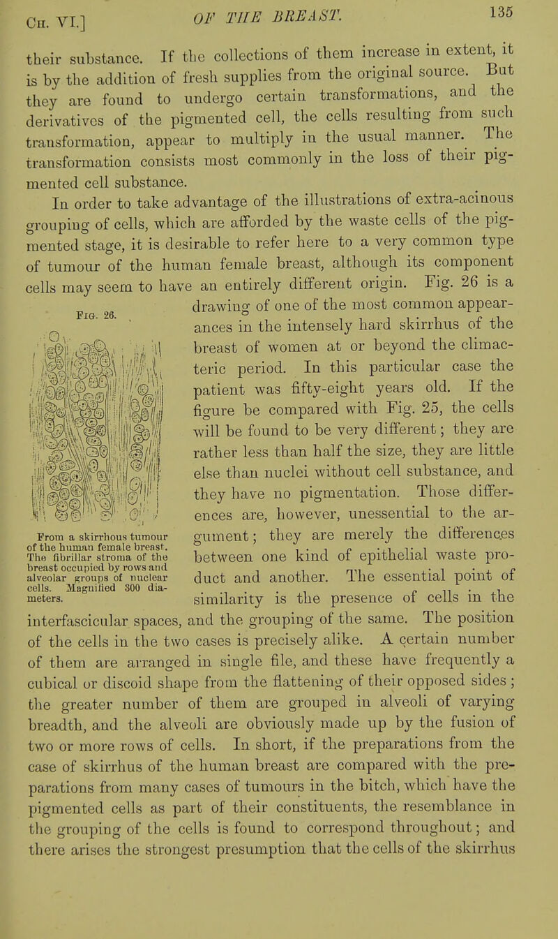 Fig. 26. their substance. If tlio collections of them increase in exten^ it is by the addition of fresh supplies from the original source But they are found to undergo certain transformations, and the derivatives of the pigmented cell, the cells resulting from such transformation, appear to multiply in the usual manner.^ The transformation consists most commonly in the loss of their pig- mented cell substance. In order to take advantage of the illustrations of extra-acinous grouping of cells, which are afforded by the waste cells of the pig- mented stage, it is desirable to refer here to a very common type of tumour of the human female breast, although its component cells may seem to have an entirely different origin. Fig. 26 is a drawing of one of the most common appear- ances in the intensely hard skirrhus of the breast of women at or beyond the climac- teric period. In this particular case the patient was fifty-eight years old. If the figure be compared with Fig. 25, the cells will be found to be very different; they are rather less than half the size, they are little else than nuclei without cell substance, and they have no pigmentation. Those differ- ences are, however, unessential to the ar- gument ; they are merely the differences between one kind of epithelial waste pro- duct and another. The essential point of similarity is the presence of cells in the interfascicular spaces, and the grouping of the same. The position of the cells in the two cases is precisely alike. A certain number of them are arranged in single file, and these have frequently a cubical or discoid shape from the flattening of their opposed sides ; the greater number of them are grouped in alveoli of varying breadth, and the alveoli are obviously made up by the fusion of two or more rows of cells. In short, if the preparations from the case of skirrhus of the human breast are compared with the pre- parations from many cases of tumours in the bitch, which have the pigmented cells as part of their constituents, the resemblance in the grouping of the cells is found to correspond throughout; and there arises the strongest presumption that the cells of the skirrhus From a skirrhous tumour of the human female breast. The fibrillar stroma of the breast occupied by rows and alveolar groups of uuclear cells. Magnifled 300 dia- meters.