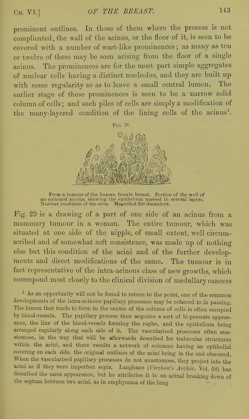 prominent outlines. In those of them where the process is not complicated, the wall of the acinus, or the floor of it, is seen to be covered with a number of wart-like prominences ; as many as ten or twelve of these may be seen arising from the floor of a single acinus. The prominences are for the most part simple aggregates of nuclear cells having a distinct nucleolus, and they are built up with some regularity so as to leave a small central lumen. The earlier stage of these prominences is seen to be a narrow solid column of cells; and such piles of cells are simply a modification of the many-layered condition of the lining cells of the acinus\ Fig. 29. From n liimour of tlie human female breast. Portion of thn wmII of aJi enlarged acnms, showing the epithelium massed in several layers. ]Vuclear_coudition of the cells. Magnified 300 diameters. Fig. 29 is a drawing of a part of one side of an acinus from a mammary tumour in a woman. The entire tumour, which was situated at one side of the nipple, of small extent, well circum- scribed and of somewhat soft consistence, was made up of nothing else but this condition of the acini and of the further develop- ments and direct modifications of the same. The tumour is in fact representative of the intra-acinous class of new growths, which correspond most closely to the clinical division of medullary cancers 1 As an opportunity will not be found to return to the point, one of the common developments of the intra-acinous papillary processes may be referred to in passing. The lumen that tends to form in the centre of the column of cells is often occupied by blood-vessels. The papillary process then acquires a sort of bi-pennate appear- auce, the hne of the blood-vessels forming the raphe, and the epithehum being arranged regularly along each side of it. The vascularised processes often ana- stomose, in the way that will be afterwards described for trabecular structm-es within the acini, and there results a network of columns having an epithehal covering on each side, the original outlines of the acini bemg in the end obscm-ed. When the vascularised papillary processes do not anastomose, they project into the acini as if they were imperfect septa. Langhans (Virchow's Archiv, Vol. 58) haa described the same appearance, but he attributes it to an actual breaking down of the septiun between two acini, as in emphysema of the lung