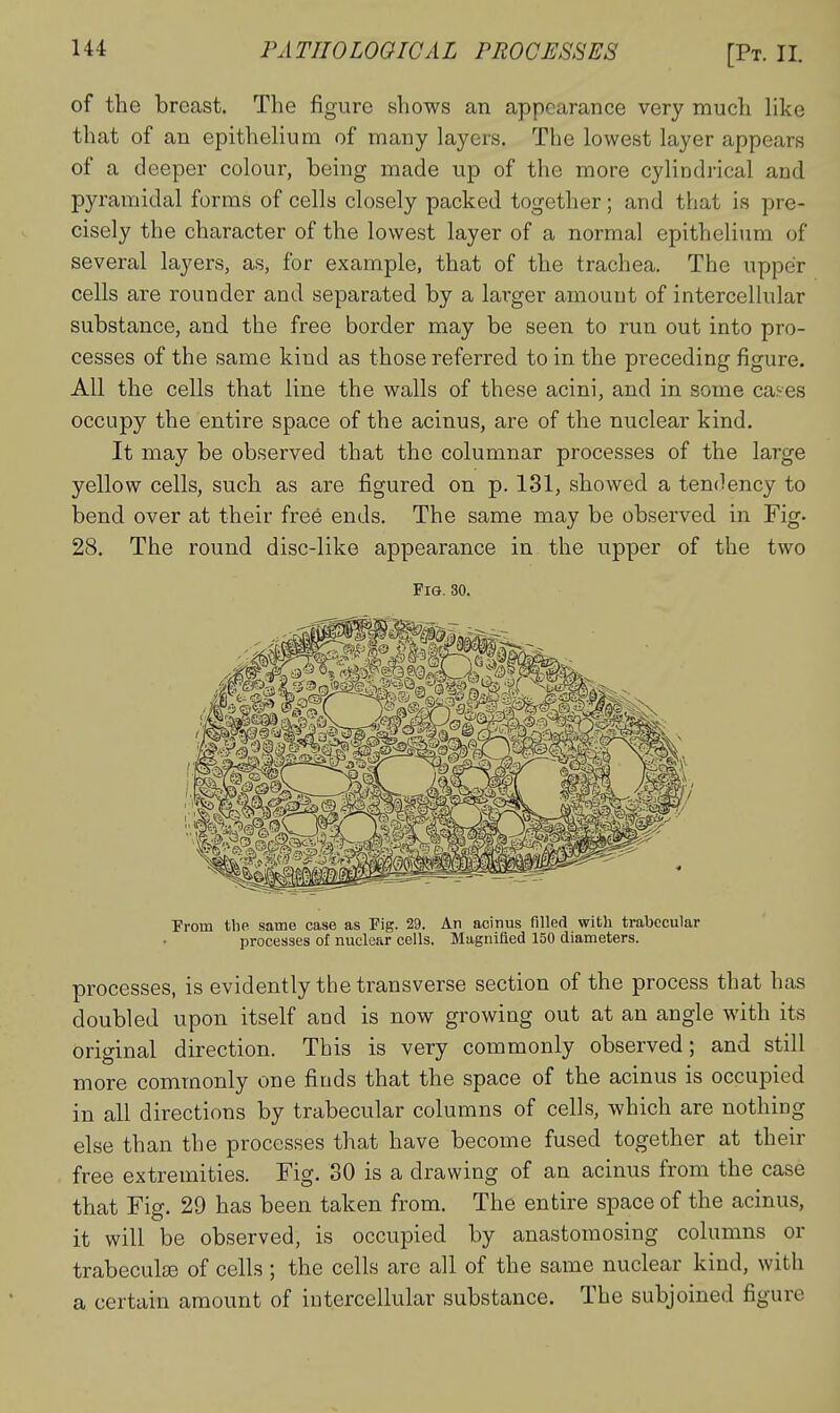 of the breast. The figure shows an appearance very much Hke that of an epithelium of many layers. The lowest layer appears of a deeper colour, being made up of the more cylindrical and pyramidal forms of cells closely packed together; and that is pre- cisely the character of the lowest layer of a normal epithelium of several layers, as, for example, that of the trachea. The upper cells are rounder and separated by a larger amount of intercellular substance, and the free border may be seen to run out into pro- cesses of the same kind as those referred to in the preceding figure. All the cells that line the walls of these acini, and in some cases occupy the entire space of the acinus, are of the nuclear kind. It may be observed that the columnar processes of the large yellow cells, such as are figured on p. 131, showed a tendency to bend over at their free ends. The same may be observed in Fig. 28. The round disc-like appearance in the upper of the two Fig. 30. Prom the same case as Pig. 29. An acinus filled with trabecular processes of nuclear cells. Magnifled 150 diameters. processes, is evidently the transverse section of the process that has doubled upon itself and is now growing out at an angle with its original direction. This is very commonly observed; and still more commonly one finds that the space of the acinus is occupied in all directions by trabecular columns of cells, which are nothing else than the processes that have become fused together at their free extremities. Fig. 30 is a drawing of an acinus from the case that Fig. 29 has been taken from. The entire space of the acinus, it will be observed, is occupied by anastomosing columns or trabeculse of cells ; the cells are all of the same nuclear kind, with a certain amount of intercellular substance. The subjoined figure