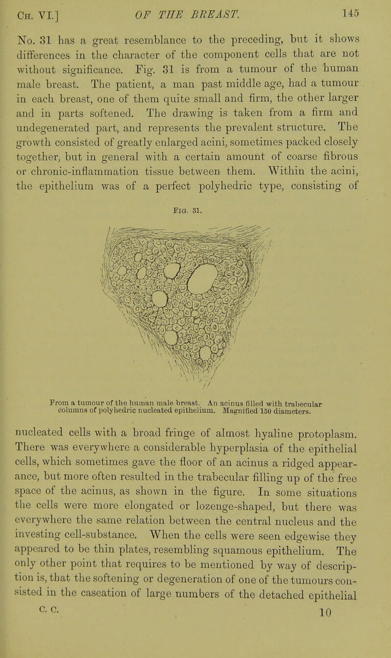 No. 31 has a great resemblance to the preceding, hwi it shows differences in the character of the component cells that are not without sionificance. Fig'. 81 is from a tumour of the human male breast. The patient, a man past middle age, had a tumour in each breast, one of them quite small and firm, the other larger and in parts softened. The drawing is taken from a firm and undegenerated part, and represents the prevalent structure. The growth consisted of greatly enlarged acini, sometimes packed closely tocrether, but in general with a certain amount of coarse fibrous or chronic-inflammation tissue between them. Within the acini, the epithelium was of a perfect polyhedric type, consistiug of EiG. 31. Prom a tumour of the human male breast. An acinus flllert with trabecular columns of polyhedi'ic nucleated epithelium. Magnitied 150 diameters. nucleated cells with a broad fringe of almost hyaline protoplasm. There was everywhere a considerable hyperplasia of the epithelial cells, which sometimes gave the floor of an acinus a ridged appear- ance, but more often resulted in the trabecular filling up of the free space of the acinus, as shown in the figure. In some situations the cells were more elongated or lozenge-shaped, but there was everywhere the same relation between the central nucleus and the investing cell-substance. When the cells were seen edgewise they appeared to be thin plates, resembling squamous epithelium. The only other point that requires to be mentioned by way of descrip- tion is, that the softening or degeneration of one of the tumours con- sisted in the caseation of large numbers of the detached epithelial