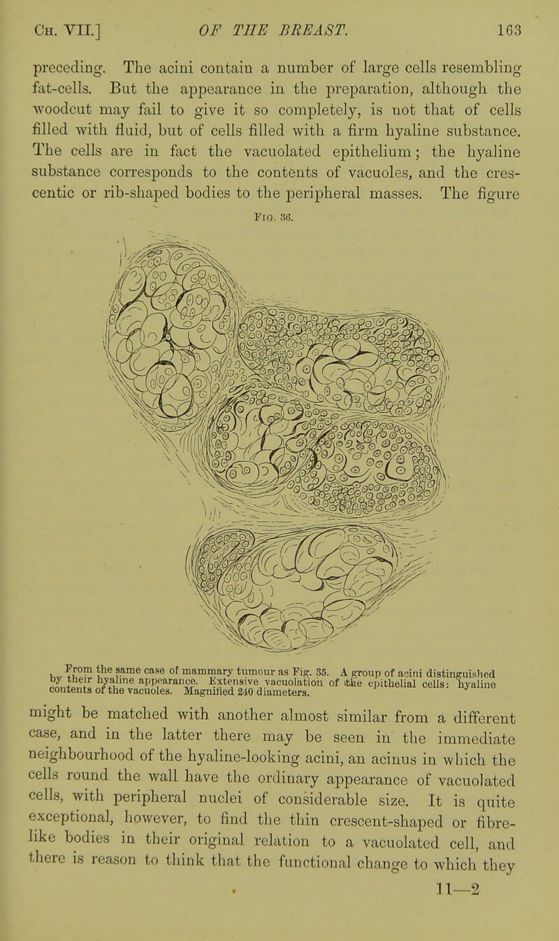 preceding. The acini contain a number of large cells resembling fat-cells. But the appearance in the preparation, although the woodcut may fail to give it so completely, is not that of cells filled with fluid, but of cells filled with a firm hyaline substance. The cells are in fact the vacuolated epithelium; the hyaline substance corresponds to the contents of vacuoles, and the cres- centic or rib-shaped bodies to the peripheral masses. The figure Fig. 36. ^^r™ I f?™® ^^ °^ mammary tumour as Fig. 35. A group of acini distinguislied by their hyaline appearance. Extensive vacuolatiou of itbe epithelial cells: hyaline contents of the vacuoles. Magnilied 240 diameters. i ^.ue.mi oeiis. nyaune might be matched with another almost similar from a different case, and in the latter there may be seen in the immediate neighbourhood of the hyaline-looking acini, an acinus in which the cells round the wall have the ordinary appearance of vacuolated cells, with peripheral nuclei of considerable size. It is quite exceptional, however, to find the thin crescent-shaped or fibre- like bodies in their original relation to a vacuolated cell, and there is reason to think that the functional change to which they 11—2