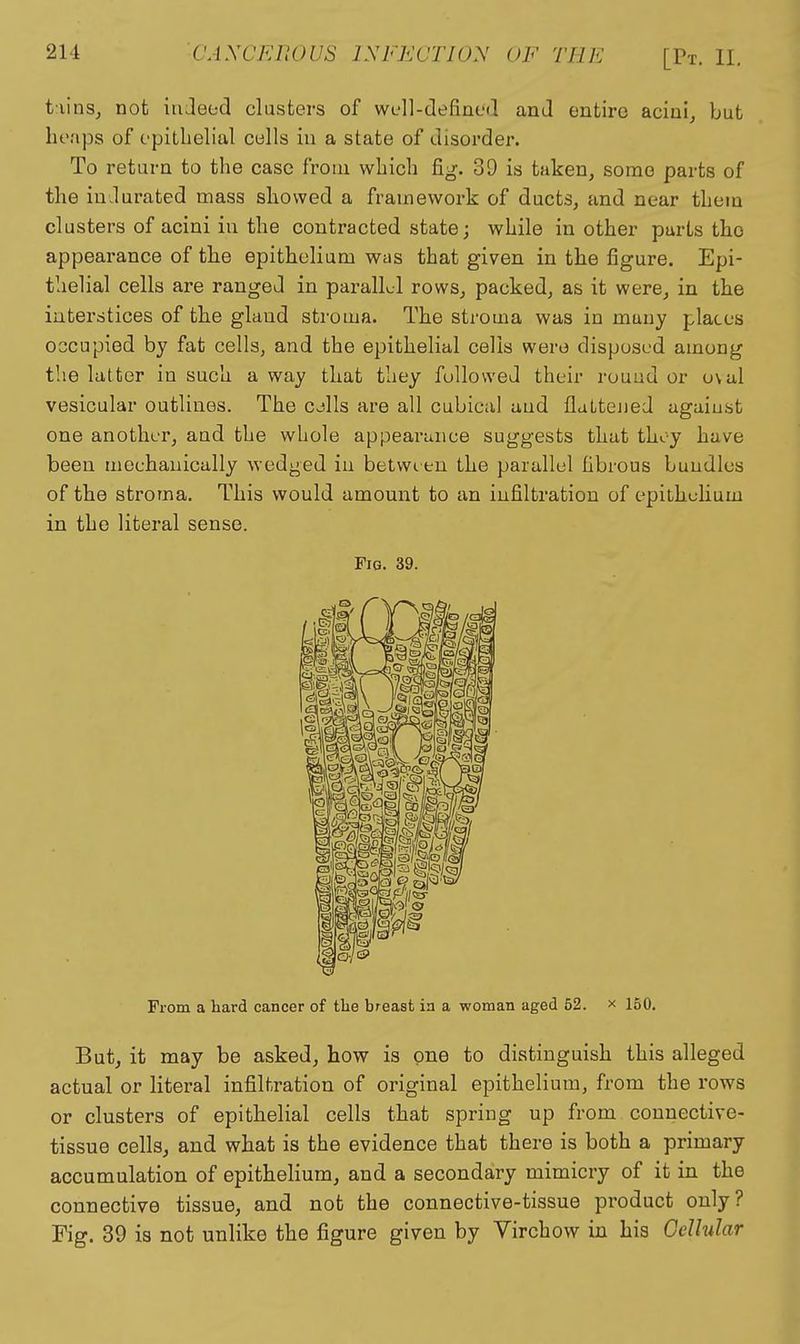 tiinSj not iiiJeed clusters of WL-ll-definod and entire acini^ but heaps of opitlielial culls in a state of disorder. To return to the case from which fig. 39 is taken, some parts of the iuJurated mass showed a framework of ducts, and near them clusters of acini iu the contracted state; while in other parts the appearance of the epithelium was that given in the figure. Epi- thelial cells are ranged in parallel rows, packed, as it were, in the iateratices of the gland stroma. The stroma was in many places occupied by fat cells, and the epithelial cells were disposed among the latter in such a way that they followed their rouud or oval vesicular outlines. The cjIIs are all cubical aud flattejied agaiust one another, aud the whole appearance suggests that thoy have been mechanically wedged iu between the parallel fibrous bundles of the stroma. This would amount to an infiltration of epithelium in the literal sense. Fig. 39. From a hard cancer of the breast in a woman aged 52. x 160. But, it may be asked, how is one to distinguish this alleged actual or literal infiltration of original epithelium, from the rows or clusters of epithelial cells that spring up from connective- tissue cells, and what is the evidence that there is both a primary accumulation of epithelium, and a secondary mimicry of it in the connective tissue, and not the connective-tissue product only? Fig. 39 is not unlike the figure given by Yirchow in his Cellular