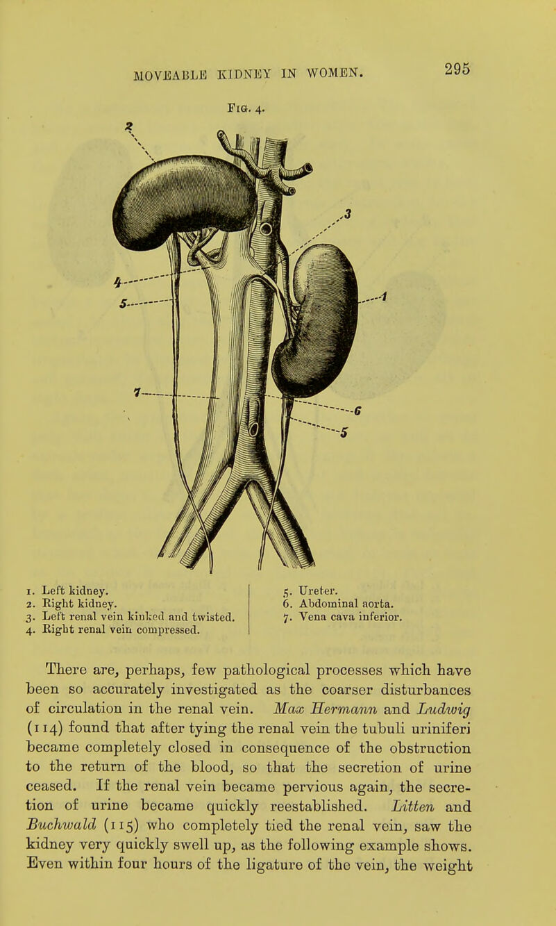 Fia. 4. 295 1. Left kidney. 2. Right kidney. 3. Left renal vein kinked and twisted. 4. Eigbt renal vein compressed. 5. Ureter. 6. Abdominal aorta. 7. Vena cava inferior. There are, perhaps, few pathological processes which have been so accurately investigated as the coarser disturbances of circulation in the renal vein. Max Hermann and Ludioig (114) found that after tying the renal vein the tubuli uriniferi became completely closed in consequence of the obstruction to the return of the blood, so that the secretion of urine ceased. If the renal vein became pervious again, the secre- tion of urine became quickly reestablished. Litten and Buchwald (115) who completely tied the renal vein, saw the kidney very quickly swell up, as the following example shows. Even within four hours of the ligature of the vein, the weight