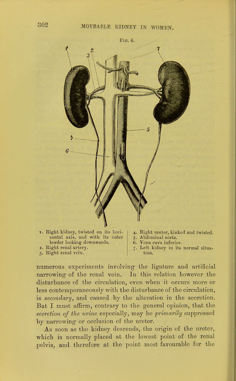 S02 Right kidney, twisted oa its liori- zontal axis, aud with its outer border loolting downwards. Right renal artery. Right renal vein. 4. Right ureter, kinked and twisted. 5. Abdominal aorta. 6. Vena cava inferior. 7. Left kidney in its normal situa- tion. numerous experiments involving the ligature and artificial narrowing of tlie renal vein. In this relation however the disturbance of the circulation, even when it occurs more or less contemporaneously with the disturbance of the circulation, is secondary, and caused by the alteration in the secretion. But I must affirm, contrary to the general opinion, that the secretion of the ^irine especially, may be primarily suppressed by narrowing or occlusion of the ureter. As soon as the kidney descends, the origin of the ureter, which is normally placed at the lowest point of the renal pelvis, and therefore at the point most favourable for the