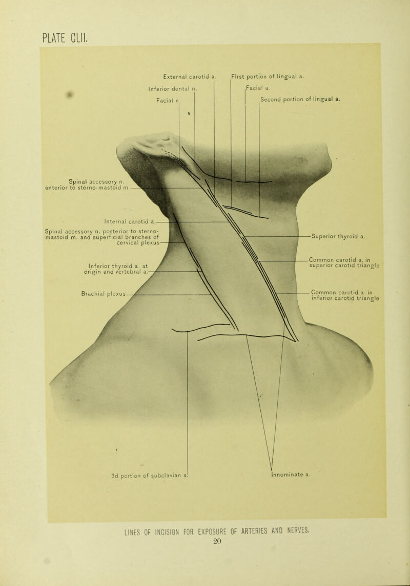 PLATE CLII. External carotid a. First portion of lingual a Inferior dental n. Facial n. Spinal accessory n anterior to sterno-mastoid m Spinal accessory n. posterior to sterno- mastoid m. and superficial branches of cervical plexus Inferior thyroid a. at origin and vertebral a. Brachial plexus Facial a. Second portion of lingual a. Superior thyroid a. Common carotid a. in superior carotid triangi Common carotid a. in inferior carotid triangi 3d portion of subclavian a nnominate a. LINES OF INCISION FOR EXPOSURE OF ARTERIES AND NERVES.