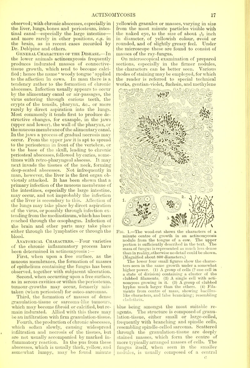 observed; with chronic abscesses, especially in the liver, hings, bones and periosteum, intes- tinal canal—especially the large intestine— and more rarely in other positions, e.g. in the brain, as in recent cases recorded by Dr. Delepine and others. General Characters of the Disease.—In the lower animals actinomycosis frequently produces indurated masses of connective- tissue growth, which tend to become calci- fied ; hence the name ' woody tongue ' applied to the affection in cows. In man there is a tendency rather to the formation of chronic abscesses. Infection usually appears to occur by the alimentary canal or air-passages, the virus entering through carious teeth, the crypts of the tonsils, pharynx, &c, or more rarely by direct aspiration into the lungs. Most commonly it tends first to produce de- structive changes, for example, in the jaws (upper and lower), the waU of the pharynx, or the mucous membrane of the alimentary canal. In the jaws a process of gradual necrosis may occur. From the upper jaw it is apt to spread to the periosteum in front of the vertebra?, or to the base of the skull, leading to chronic periosteal abscesses, followed by caries, some- times with retro-pharyngeal abscess. It may next invade the tissues of the neck, forming deep-seated abscesses. Not infrequently in man, however, the liver is the first organ ob- viously attacked. It has been shown that a primary infection of the mucous membrane of the intestines, especially the large intestine, may occur, and not improbably the infection of the liver is secondary to this. Affection of the lungs may take place by direct aspiration of the virus, or possibly through infection ex- tending from the mediastinum, which has been reached through the oesophagus. Infection of the brain and other parts may take place either through the lymphatics or through the blood. Anatomical Characters.—Four varieties of the chronic inflammatory process have been determined in actinomycosis :— First, when upon a free surface, as the mucous membranes, the formation of masses of epithelium containing the fungus has been observed, together with subjacent idceration. Second, when occurring upon a free surface, as in serous cavities or within the periosteum, tmnour-growths may occur, formerly mis- taken (when periosteal) for osteo-sarcomas. Third, the formation cf masses of dense granulation-tissue or sarcoma-like tumours, which may become fibroid or calcified, but re- main indurated. Allied with this there may be an infiltration with firm granulation-tissue. Fourth, the production of chronic abscesses, which soften slowly, causing widespread infiltration and necrosis of the tissues, but are not usually accompanied by marked in- flammatory reaction. In the pus from these abscesses, which is usually thick, yellow, and somewhat lumpy, may be found minute yellowish granules or masses, varying in size from the most minute particles visible with the naked eye, to the size of about inch in diameter, of yellowish colour, ovoid or rounded, and of slightly greasy feel. Under the microscope these are found to consist of masses of the ray-fungus. On microscopical examination of jirepared sections, especiaUy in the firmer nodules, the characters can be better seen. Various modes of staining may be employed, for which the reader is referred to special technical works, gentian-violet, fuchsin, and methylene Fig. I.—The wood-cut shows the characters of a minute centre of growth in an actinomycosis nodule from the tongue of a cow. The upper portion is sufficiently described in the text. The mass of fungus is represented as much less dense than in reality, otherwise no detail could be shown. (Magnified about 800 diameters.) The lower four small figures show the charac- ters seen in the same growth under a somewhat higher power. (1) A group of cells (? one cell in a state of division) containing a cluster of the clubbed filaments. (2) A single cell with acti- nomyces growing in it. (3) A group of clubbed hyphce much larger than the others. (4) Fila- ments from centre of mass, showing bacillus- like characters, and false branching; resembling cladothrix. blue being amongst the most suitable re- agents. The structure is composed of granu- lation-tissue, either small or large-celled, frequently with branching and spindle cells, resembling spindle-celled sarcoma. Scattered through the granulation-tissue are deeply stained masses, which form the centre of more typically arranged masses of cells. The fungus itself, when seen in the smaller nodules, is usually composed of a central