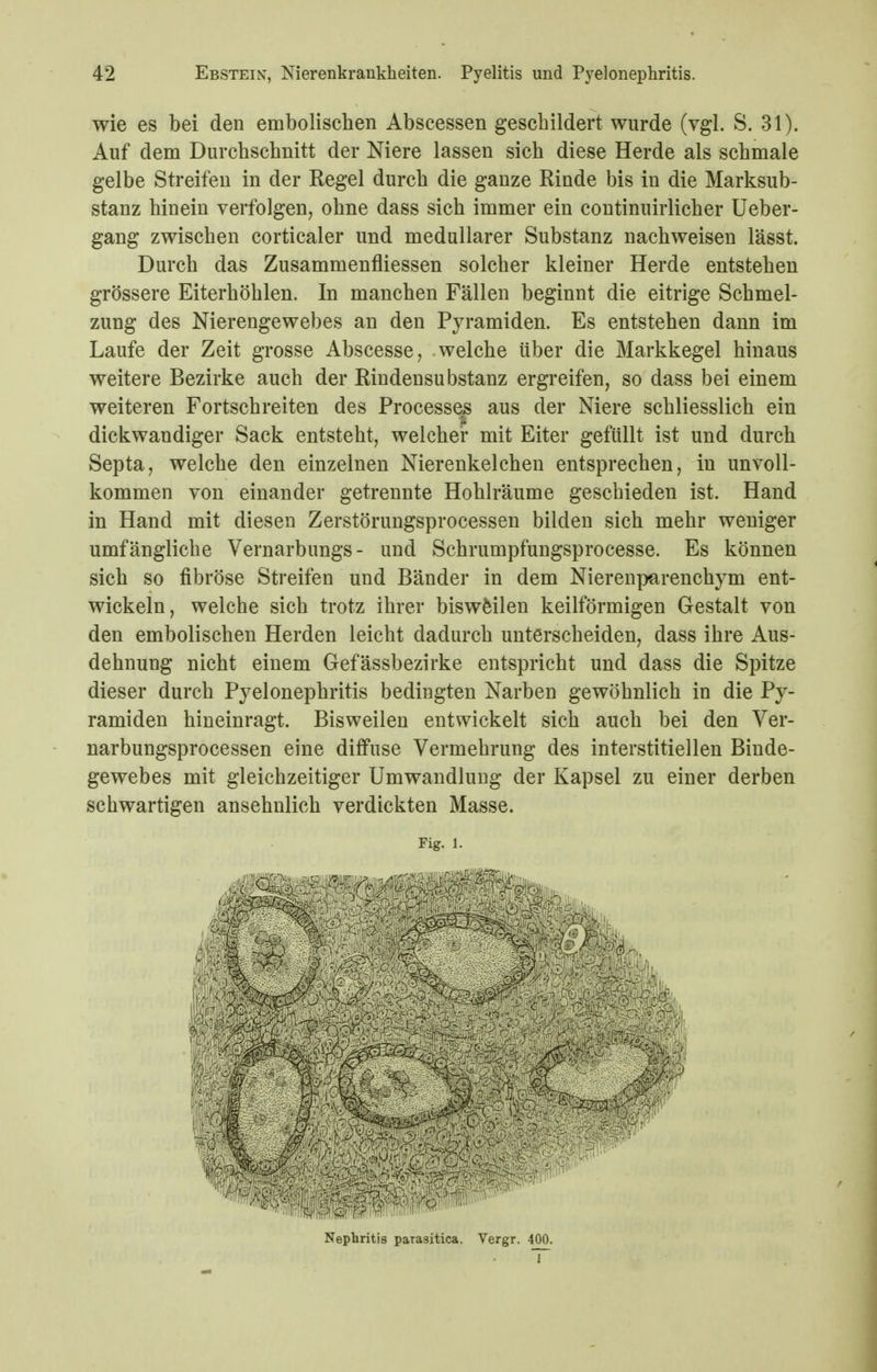 wie es bei den embolischen Abseessen geschildert wurde (vgl. S. 31). Auf dem Durchschnitt der Niere lassen sich diese Herde als schmale gelbe Streifen in der Regel durch die ganze Rinde bis in die Marksub- stanz hinein verfolgen, ohne dass sich immer ein continuirlicher Ueber- gang zwischen corticaler und medullärer Substanz nachweisen lässt. Durch das Zusammenfliessen solcher kleiner Herde entstehen grössere Eiterhöhlen. In manchen Fällen beginnt die eitrige Schmel- zung des Nierengewebes an den Pyramiden. Es entstehen dann im Laufe der Zeit grosse Abscesse, welche über die Markkegel hinaus weitere Bezirke auch der Rindensubstanz ergreifen, so dass bei einem weiteren Fortschreiten des Processes aus der Niere schliesslich ein dickwandiger Sack entsteht, welcher mit Eiter gefüllt ist und durch Septa, welche den einzelnen Nierenkelchen entsprechen, in unvoll- kommen von einander getrennte Hohlräume geschieden ist. Hand in Hand mit diesen Zerstörungsprocessen bilden sich mehr weniger umfängliche Vernarbungs- und Schrumpfungsprocesse. Es können sich so fibröse Streifen und Bänder in dem Nierenparenchym ent- wickeln, welche sich trotz ihrer biswMlen keilförmigen Gestalt von den embolischen Herden leicht dadurch unterscheiden, dass ihre Aus- dehnung nicht einem Gefässbezirke entspricht und dass die Spitze dieser durch Pyelonephritis bedingten Narben gewöhnlich in die Py- ramiden hineinragt. Bisweilen entwickelt sich auch bei den Ver- narbungsprocessen eine diffuse Vermehrung des interstitiellen Binde- gewebes mit gleichzeitiger Umwandlung der Kapsel zu einer derben schwartigen ansehnlich verdickten Masse. Fig. 1. 4!- Nephritis parasitica. Vergr. 400.