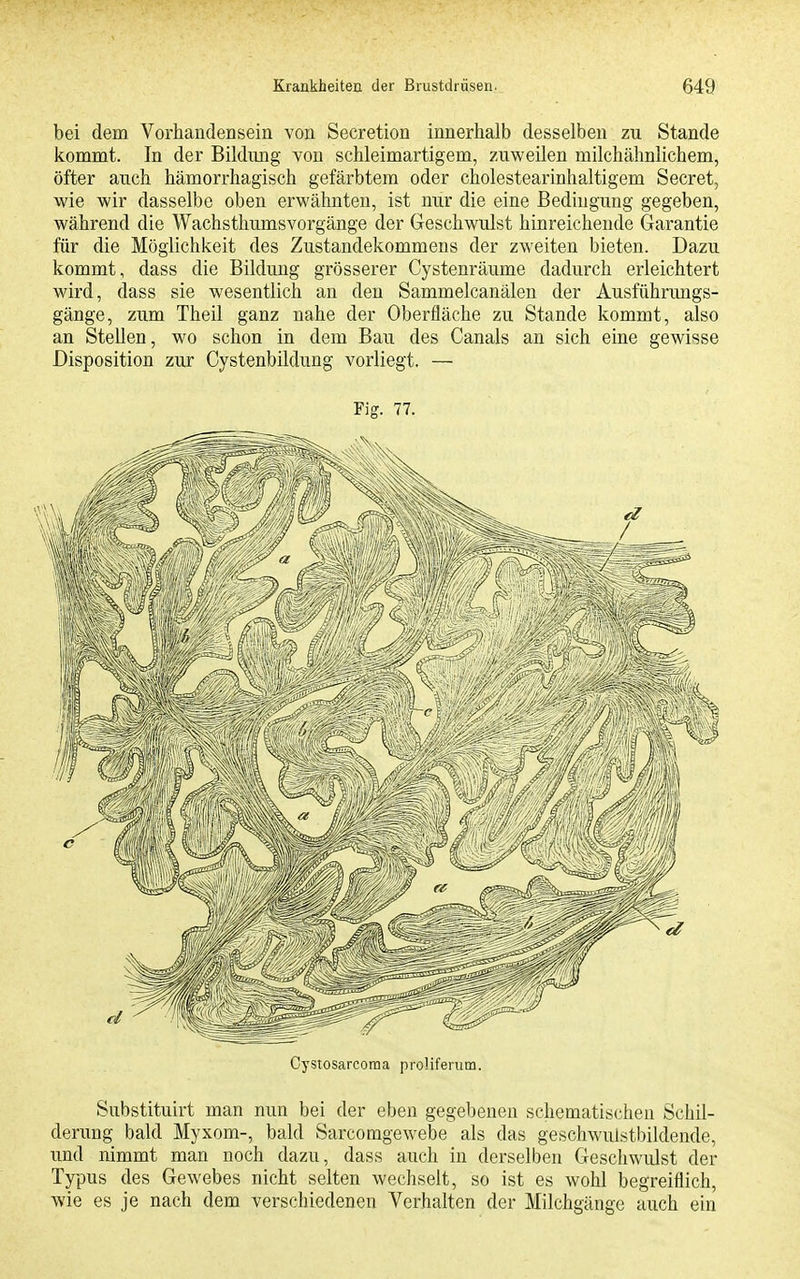 bei dem Vorhandeasein von Secretion innerhalb desselben zu Stande kommt. In der Bildung von schleimartigem, zuweilen milchähnlichem, öfter auch hämorrhagisch gefärbtem oder cholestearinhaltigem Secret, wie wir dasselbe oben erwähnten, ist nur die eine Bedingung gegeben, während die Wachsthumsvorgänge der Geschwulst hinreichende Garantie für die Möglichkeit des Zustandekommens der zweiten bieten. Dazu kommt, dass die Bildung grösserer Cystenräume dadurch erleichtert wird, dass sie wesentlich an den Sammelcanälen der Ausführungs- gänge, zum Theil ganz nahe der Oberfläche zu Stande kommt, also an Stellen, wo schon in dem Bau des Canals an sich eine gewisse Disposition zur Cystenbildung vorliegt. — Fig. 77. Cystosarcoraa proliferum. Substituirt man nun bei der eben gegebenen schematischeu Schil- derung bald Myxom-, bald Sarcoragewebe als das geschwulstbildende, imd nimmt man noch dazu, dass auch in derselben Geschwulst der Typus des Gewebes nicht selten wechselt, so ist es wohl begreiflich, wie es je nach dem verschiedenen Verhalten der Milchgänge auch ein