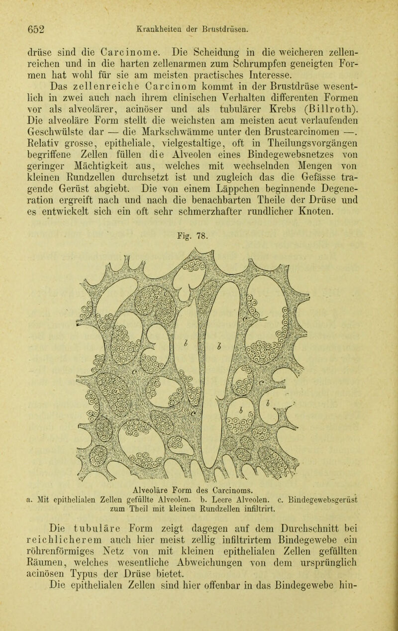 drüse sind die Carcinome. Die Scheidung in die weicheren zellen- reichen und in die harten zellenarmen zum Schrumpfen geneigten For- men hat wohl für sie am meisten practisches Interesse. Das zellenreiche Carcinom kommt in der Brustdrüse wesent- lich in zwei auch nach ihrem clinischen Verhalten differenten Formen vor als alveolärer, acinöser und als tubulärer Krebs (ßillroth). Die alveoläre Form stellt die weichsten am meisten acut verlaufenden Geschwülste dar — die Markschwämme unter den ßrustcarcinomen —. Eelativ grosse, epitheliale, vielgestaltige, oft in Theilungsvorgängen begrilfene Zellen füllen die Alveolen eines Bindegewebsnetzes von geringer Mächtigkeit aus, welches mit wechselnden Mengen von kleinen Kundzellen durchsetzt ist und zugleich das die Gefässe tra- gende Gerüst abgiebt. Die von einem Läppchen beginnende Degene- ration ergreift nach und nach die benachbarten Theile der Drüse und es entwickelt sich ein oft sehr schmerzhafter rundlicher Knoten. Fig. 78. Alveoläre Form des Carcinoms. a. Mit epithelialen Zellen gefüllte Alveolen, b. Leere Alveolen, c. Bindegewebsgerüst zum Theil mit kleinen Riindzellen infiltrirt. Die tubuläre Form zeigt dagegen auf dem Durchschnitt bei reichlicherem auch hier meist zellig iufiltrirtem Bindegewebe eiu röhrenförmiges Netz von mit kleinen epithelialen Zellen gefüllten Bäumen, welches wesentliche Abweichungen von dem ursprünglich acinösen Typus der Drüse bietet. Die epithelialen Zellen sind hier offenbar in das Bindegewebe hin-