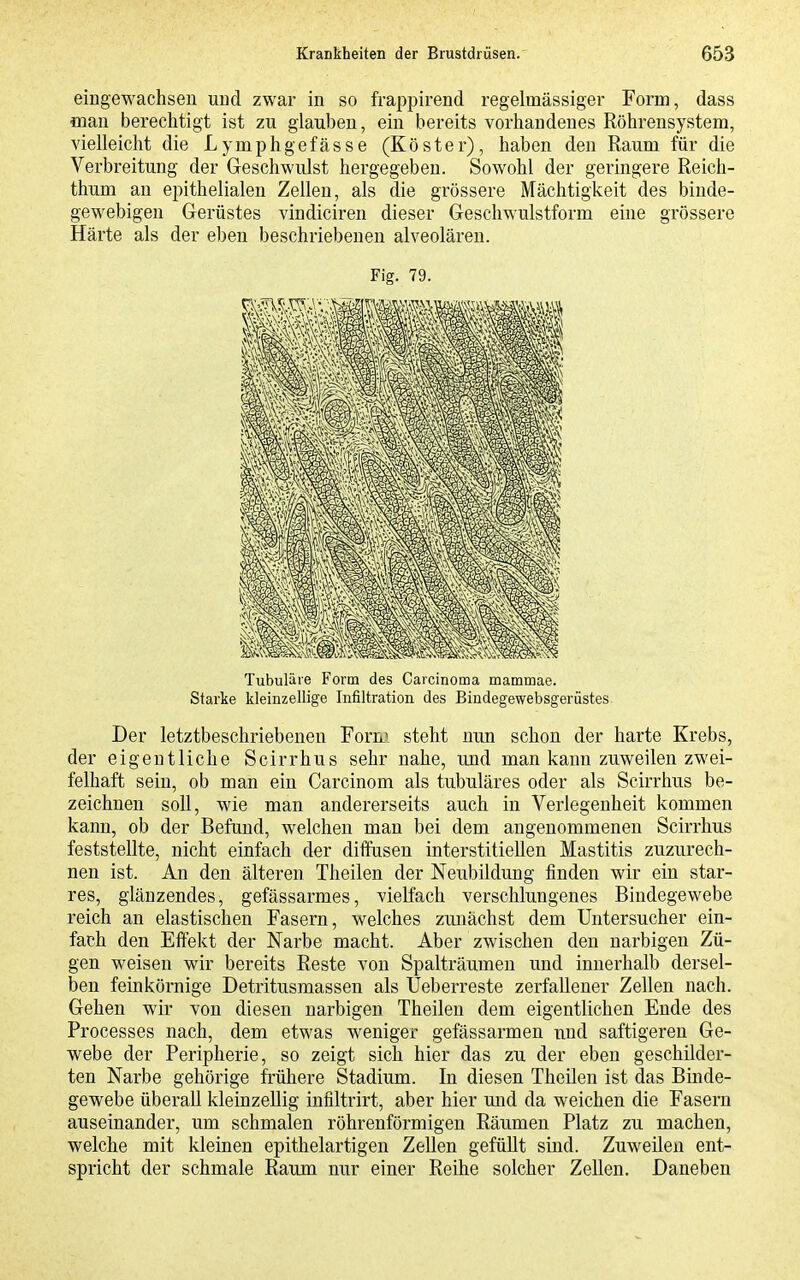 eingewachsen und zwar in so frappirend regelmässiger Form, dass man berechtigt ist zu glauben, ein bereits vorhandenes Röhrensystem, vielleicht die Lymphgefässe (Köster), haben den Raum für die Verbreitung der Geschwulst hergegeben. Sowohl der germgere Reich- thum an epithelialen Zellen, als die grössere Mächtigkeit des binde- gewebigen Gerüstes vindiciren dieser Geschwulstform eine grössere Härte als der eben beschriebenen alveolären. Fig. 79. Tubuläre Form des Carcinoma mammae. Starke kleinzellige Infiltration des Bindegewebsgerüstes^ Der letztbeschriebenen Forn' steht nun schon der harte Krebs, der eigentliche Scirrhus sehr nahe, und man kann zuweilen zwei- felhaft sein, ob man ein Carcinom als tubuläres oder als Scirrhus be- zeichnen soll, wie man andererseits auch in Verlegenheit kommen kann, ob der Befand, welchen man bei dem angenommenen Scirrhus feststellte, nicht einfach der diffusen interstitiellen Mastitis zuzurech- nen ist. An den älteren Theilen der Neubildung finden wir ein star- res, glänzendes, gefässarmes, vielfach verschlungenes Bindegewebe reich an elastischen Fasern, welches zmiächst dem Untersucher ein- fach den Effekt der Narbe macht. Aber zwischen den narbigen Zü- gen weisen wir bereits Reste von Spalträumen und innerhalb dersel- ben feinkörnige Detritusmassen als Ueberreste zerfallener Zellen nach. Gehen wir von diesen narbigen Theilen dem eigentlichen Ende des Processes nach, dem etwas weniger gefässarmen und saftigeren Ge- webe der Peripherie, so zeigt sich hier das zu der eben geschilder- ten Narbe gehörige frühere Stadium. In diesen Theilen ist das Binde- gewebe überall kleinzellig infiltrirt, aber hier und da weichen die Fasern auseinander, um schmalen röhrenförmigen Räumen Platz zu machen, welche mit kleinen epithelartigen Zellen gefüllt sind. Zuweilen ent- spricht der schmale Raum nur einer Reihe solcher Zellen. Daneben