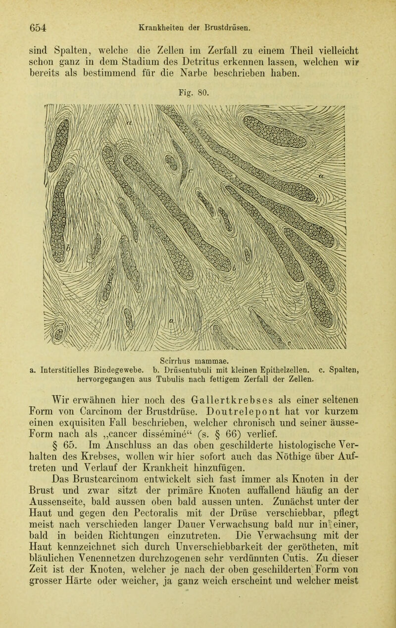 sind Spalten, welche die Zellen im Zerfall zu einem Theil vielleicht schon ganz in dem Stadium des Detritus erkennen lassen, welchen wir bereits als bestimmend für die Narbe beschrieben haben. Fig. 80. Scirrhus mammae. a. Interstitielles Bindegewebe, b. Drüsentubuli mit kleinen Epithelzellen, c. Spalten, hervorgegangen aus Tubulis nach fettigem Zerfall der Zellen. Wir erwähnen hier noch des Gallertkrebses als einer seltenen Form von Carcinom der Brustdrüse. Doutrelepont hat vor kurzem einen exquisiten Fall beschrieben, welcher chronisch und seiner äusse- Form nach als ,,Cancer dissemine (s. § 66) verlief. § 65. Im Anschluss an das oben geschilderte histologische Ver- halten des Krebses, wollen wir hier sofort auch das Nöthige über Auf- treten und Verlauf der Krankheit hinzufügen. Das Brustcarcinom entwickelt sich fast immer als Knoten in der Brust und zwar sitzt der primäre Knoten auffallend häufig an der Aussenseite, bald aussen oben bald aussen unten. Zunächst unter der Haut und gegen den Pectoralis mit der Drüse verschiebbar, pflegt meist nach verschieden langer Dauer Verwachsung bald nur in'i einer, bald in beiden Eichtungen einzutreten. Die Verwachsung mit der Haut kennzeichnet sich durch Unverschiebbarkeit der gerötheten, mit bläulichen Venennetzen durchzogenen sehr verdünnten Cutis. Zu dieser Zeit ist der Knoten, welcher je nach der oben geschilderten Form von grosser Härte oder weicher, ja ganz weich erscheint und welcher meist