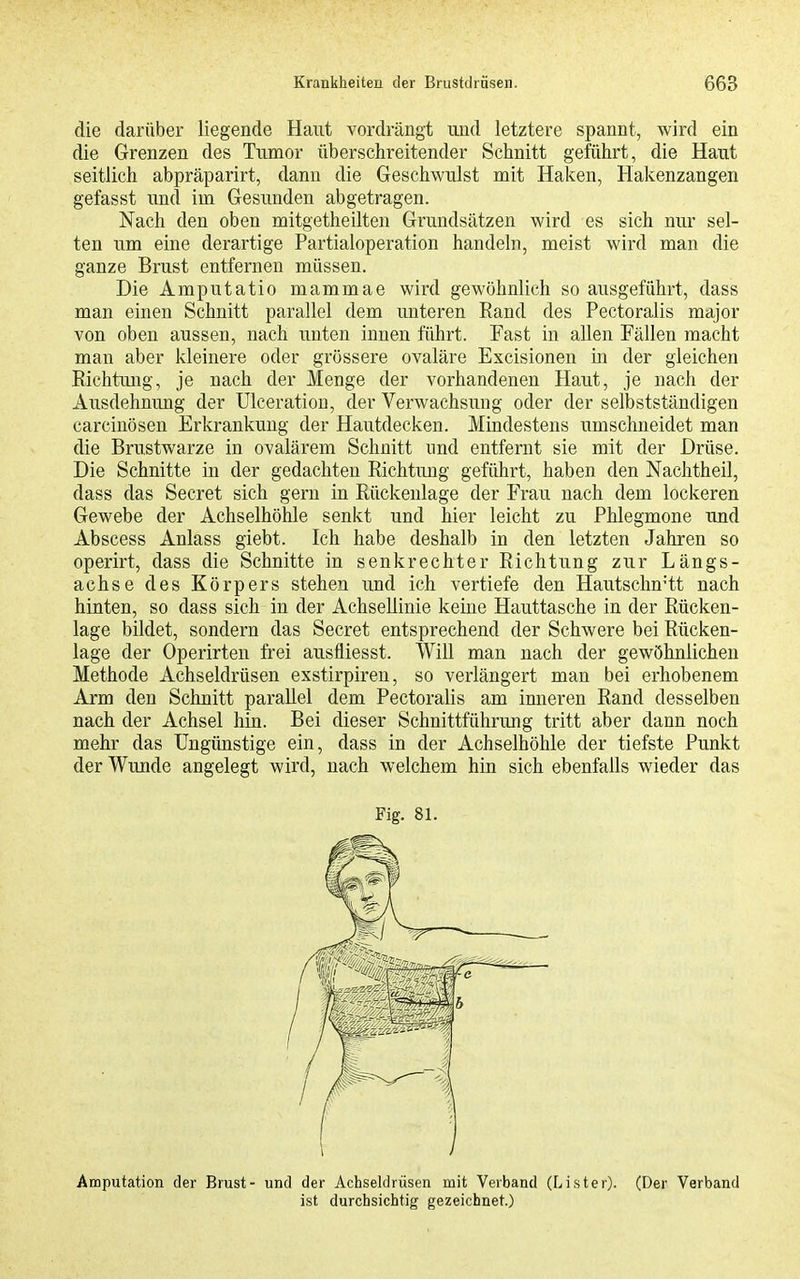die darüber liegende Haut vordrängt und letztere spannt, wird ein die Grenzen des Tumor überschreitender Schnitt geführt, die Haut seitlich abpräparirt, dann die Geschwulst mit Haken, Hakenzangen gefasst und im Gesunden abgetragen. Nach den oben mitgetheilten Grundsätzen wird es sich nur sel- ten um eine derartige Partialoperation handeln, meist wird man die ganze Brust entfernen müssen. Die Amputatio mammae wird gewöhnlich so ausgeführt, dass man einen Schnitt parallel dem unteren Eand des Pectoralis major von oben aussen, nach unten innen führt. Fast in allen Fällen macht man aber kleinere oder grössere ovaläre Excisionen in der gleichen Eichtung, je nach der Menge der vorhandenen Haut, je nach der Ausdehnung der Ulceratiou, der Verwachsung oder der selbstständigen carcinösen Erkrankung der Hautdecken. Mindestens umschneidet man die Brustwarze in ovalärem Schnitt und entfernt sie mit der Drüse. Die Schnitte in der gedachten Richtung geführt, haben den Nachtheil, dass das Secret sich gern in Rückenlage der Frau nach dem lockeren Gewebe der Achselhöhle senkt und hier leicht zu Phlegmone und Abscess Anlass giebt. Ich habe deshalb in den letzten Jahren so operirt, dass die Schnitte in senkrechter Richtung zur Längs- achse des Körpers stehen und ich vertiefe den HautschnHt nach hinten, so dass sich in der Achsellinie keine Hauttasche in der Rücken- lage bildet, sondern das Secret entsprechend der Schwere bei Rücken- lage der Operirten frei ausüiesst. Will man nach der gewöhnlichen Methode Achseldrüsen exstirpiren, so verlängert man bei erhobenem Arm den Schnitt parallel dem Pectoralis am inneren Rand desselben nach der Achsel hin. Bei dieser Schnittführung tritt aber dann noch mehr das Ungünstige ein, dass in der Achselhöhle der tiefste Punkt der Wunde angelegt wird, nach welchem hin sich ebenfalls wieder das Fig. 81. Amputation der Brust- und der Achseldrüsen mit Verband (Lister). (Der Verband ist durchsichtig gezeichnet.)