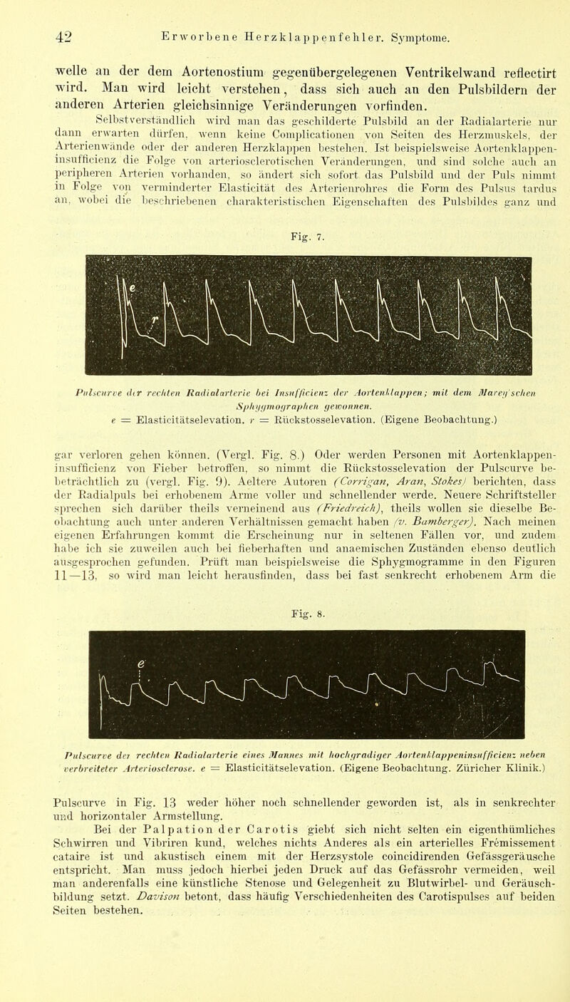 welle an der dem Aortenostium gegenübergelegejaen Ventrikelwand reflectirt wird. Man wird leicht verstehen, dass sich auch an den Pulsbildern der anderen Arterien gleichsinnige Veränderungen vorfinden. Selbstverständlicli wird man das gescliilderte Pnlsbild an der Eadialarterie nur dann erwarten dürfen, wenn keine Complicationen von Seiten des Herzmuskels, der Arterienwände oder der anderen Herzklappen bestehen. Ist beispielsweise Aortenklappen- insufficienz die Folge von arteriosclerotischen Veränderungen, und sind solche auch an peripheren Arterien vorhanden, so ändert sich sofort das Pulsbild und der Puls nimmt in Folge von verminderter Elasticität des Arterienrohres die Form des Pulsus tardus an, wobei die beschriebenen charakteristischen Eigenschaften des Pulsbildes ganz und Fig. 7. Pvliciirce dir reclden Radialarterie hei Imtifficimz der Aortenidappen; mit dem ß/arei/ sc/ieii Sptiijtimofjraplien gewonnen, e — Elasticitätselevation. r = Eüekstosselevation. (Eigene Beobachtung.) gar verloren gehen können. (Vergl. Fig. 8.) Oder werden Personen mit Aortenklappen- insufflcienz von Fieber betroifen, so nimmt die Eüekstosselevation der Pulscurve be- beträchtlich zu (vergl. Fig. 9). Aeltere Autoren (Corrigan, Aran, Stokesl berichten, dass der Radialpuls bei erhobenem Arme voller und schnellender werde. Neuere Schriftsteller sprechen sich darüber theils verneinend aus (Friedreüh), theils wollen sie dieselbe Be- obachtung auch unter anderen Verhältnissen gemacht haben fv. Bamberger). Nach meinen eigenen Erfahrungen kommt die Erscheinung nur in seltenen Fällen vor, und zudem habe ich sie zuweilen auch bei fieberhaften und anaemischen Zuständen ebenso deutlich ausgesprochen gefunden. Prüft man beispielsweise die Sphygmogramme in den Figuren 11—13, so wird man leicht herausfinden, dass bei fast senkrecht erhobenem Arm die Fig. 8. Pulscurve der rec/iten liadialarlerie eines Mannes mit /ioc/ii/radi//er Aorten/,lappeninsiif/irien-. neljen verbreiteter Arteriosclerose. e = Elasticitätselevation. (Eigene Beobachtung. Züricher Klinik.) Pulscurve in Fig. 13 weder höher noch schnellender geworden ist, als in senkrechter und horizontaler Armstellung. Bei der Palpation der Carotis giebf sich nicht selten ein eigenthümliches Schwirren und Vibriren kund, welches nichts Anderes als ein arterielles Fremissement cataire ist und akustisch einem mit der Herzsystole coincidirenden Gefässgeräusche entspricht. Man muss jedoch hierbei jeden Druck auf das Gefässrohr vermeiden, weil man anderenfalls eine künstliche Stenose und Gelegenheit zu Blutwirbel- und Geräusch- bildung setzt. Davison betont, dass häufig Verschiedenheiten des Carotispulses auf beiden Seiten bestehen.
