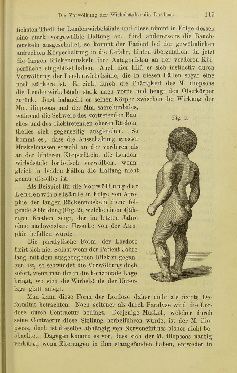 liebsten Tlieil der Lendenwirbelsäule und diese nimmt in Folge dessen eine stark vorgewölbte Haltung an. Sind andererseits die Bauch- muskeln ausgeschaltet, so kommt der Patient bei der gewöhnlichen aufrechten Körperhaltung in die Gefahr, hinten überzufallen, da jetzt die langen Rückenmuskeln ihre Antagonisten an der vorderen Kör- perfläche eingebüsst haben. Auch hier hilft er sich instinctiv durch Vorwölbung der Lendenwirbelsäule, die in diesen Fällen sogar eine noch stärkere ist. Er zieht durch die Thätigkeit des M. iliopsoas die Lendenwirbelsäule stark nach vorne und beugt den Oberkörper zurück. Jetzt balancirt er seinen Körper zwischen der Wirkung der Mm. iliopsoas und der Mm. sacrolumbales, während die Schwere des vortretenden Bau- ches und des rücktretenden oberen Rücken- theiles sich gegenseitig ausgleichen. So kommt es, dass die Ausschaltung grosser Muskelmassen sowohl an der vorderen als an der hinteren Körperfläche die Lenden- wirbelsäule lordotisch vorwölben, wenn- gleich in beiden Fällen die Haltung nicht genau dieselbe ist. Als Beispiel für die Vor Wölbung der Lendenwirbelsäule in Folge von Atro- phie der langen Rückenmuskeln diene fol- gende Abbildung (Fig. 2), welche einen 4jäh- rigen Knaben zeigt, der im letzten Jahre ohne nachweisbare Ursache von der Atro- phie befallen wurde. Die paralytische Form der Lordose fixirt sich nie. Selbst wenn der Patient Jahre lang mit dem ausgebogenen Rücken gegan- gen ist, so schwindet die Vorwölbung doch sofort, wenn man ihn in die horizontale Lage bringt, wo sich die Wirbelsäule der Unter- lage glatt anlegt. Man kann diese Form der Lordose daher nicht als fixirte De- formität betrachten. Noch seltener als durch Paralyse wird die Lor- dose durch Contractur bedingt. Derjenige Muskel, welcher durch seine Contractur diese Stellung herbeiführen würde, ist der M. ilio- psoas, doch ist dieselbe abhängig von Nerveneinfluss bisher nicht be- obachtet. Dagegen kommt es vor, dass sich der M. iliopsoas narbig verkürzt, wenn Eiterungen in ihm stattgefunden haben, entweder in