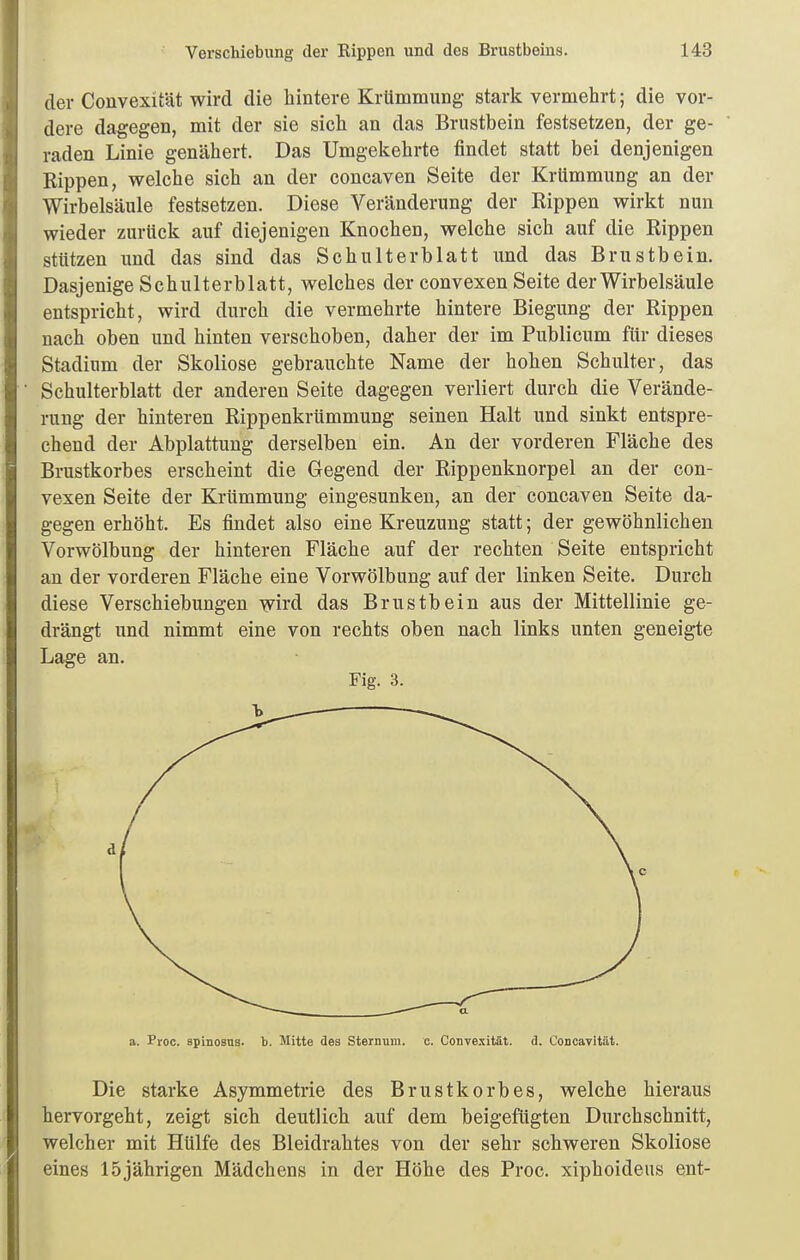 der Convexität wird die hintere Krümmung stark vermehrt; die vor- dere dagegen, mit der sie sich an das Brustbein festsetzen, der ge- raden Linie genähert. Das Umgekehrte findet statt bei denjenigen Rippen, welche sich an der concaven Seite der Krümmung an der Wirbelsäule festsetzen. Diese Veränderung der Rippen wirkt nun wieder zurück auf diejenigen Knochen, welche sich auf die Rippen stützen und das sind das Schulterblatt und das Brustbein. Dasjenige Schulterblatt, welches der convexen Seite der Wirbelsäule entspricht, wird durch die vermehrte hintere Biegung der Rippen nach oben und hinten verschoben, daher der im Publicum für dieses Stadium der Skoliose gebrauchte Name der hohen Schulter, das Schulterblatt der anderen Seite dagegen verliert durch die Verände- rung der hinteren Rippenkrümmung seinen Halt und sinkt entspre- chend der Abplattung derselben ein. An der vorderen Fläche des Brustkorbes erscheint die Gegend der Rippenknorpel an der con- vexen Seite der Krümmung eingesunken, an der concaven Seite da- gegen erhöht. Es findet also eine Kreuzung statt; der gewöhnlichen Vorwölbung der hinteren Fläche auf der rechten Seite entspricht an der vorderen Fläche eine Vorwölbung auf der linken Seite. Durch diese Verschiebungen wird das Brustbein aus der Mittellinie ge- drängt und nimmt eine von rechts oben nach links unten geneigte Lage an. Fig. 3. a. Proc. spinosns. b. Mitte des Sternum. c. Convexität. ä. Concavität. Die starke Asymmetrie des Brustkorbes, welche hieraus hervorgeht, zeigt sich deutlich auf dem beigefügten Durchschnitt, welcher mit Hülfe des Bleidrahtes von der sehr schweren Skoliose eines 15jährigen Mädchens in der Höhe des Proc. xiphoideus ent-