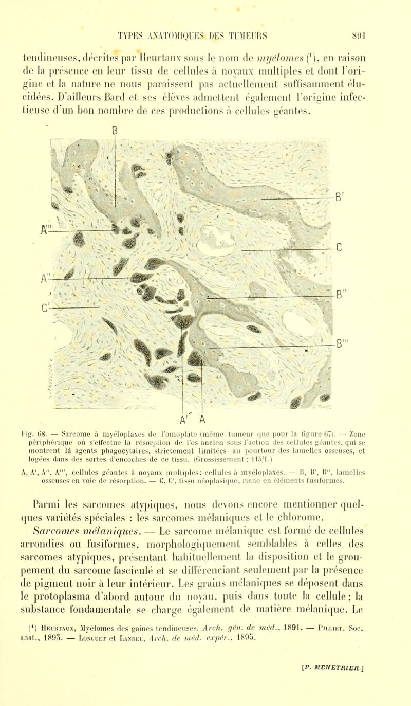 tendineuses, décrites par Hcurtaux sous le nom de myélomes^), en raison de la présence en leur tissu de cellules à noyaux multiples et dont l'ori- gine et la nature ne nous paraissent pas actuellement suffisamment élu- cidées. D'ailleurs Bard et ses élèves admettent également l'origine infec- tieuse d'un bon nombre de ces productions à cellules géantes. B Àr A Fig. 68. — Sarcome à myéloplaxes de l'omoplate (même tumeur que pour la figure 67). — Zone périphérique où s'effectue la résorption de l'os ancien sous l'action des cellules géantes, qui se montrent là agents phagocytaires, strictement limitées au pourtour des lamelles osseuses, et logées dans des sortes d'encoches de ce tissu. (Grossissement : 115/1.) A, A', A, A', cellules géantes à noyaux multiples; cellules à myéloplaxes. — B, B', B, lamelles osseuses en voie de résorption. — C, C, tissu néoplasique, riche en éléments fusiformes. Parmi les sarcomes atypiques, nous devons encore mentionner quel- ques variétés spéciales : les sarcomes mélaniques et le chlorome. Sarcomes mélaniques.— Le sarcome mélanique est formé de cellules arrondies ou fusiformes, morphologiquement semblables à celles des sarcomes atypiques, présentant habituellement la disposition et le grou- pement du sarcome fasciculé et se différenciant seulement par la présence de pigment noir à leur intérieur. Les grains mélaniques se déposent dans le protoplasma d'abord autour du noyau, puis dans toute la cellule; la substance fondamentale se charge également de matière mélanique. Le (*) Heurtaux, Myélomes des gaines tendineuses. Arch. gén. de méd., 1891. — Pïliiet, Soc. anat., 1893. — Longuet et Landel, Arch. de méd. expér., 1895.