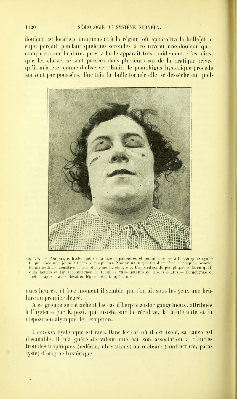 douleur est localisée uniquement à la région où apparaîtra la bulleet le sujet perçoit pendant quelques secondes à ce niveau une douleur qu'il compare aune brûlure, puis la bulle apparaît très rapidement. C'est ainsi que les choses se sont passées dans plusieurs cas de la pratique privée qu'il m'a été donné d'observer. Enfin le pemphigus hystérique procède souvent par poussées. Une l'ois la bulle formée elle se dessèche en quel- Fig. 297. — Pemphigus hystérique de la face — paupières et pommettes — à topographie symé- trique chez une jeune lille de dix-sept ans. Nombreux stigmates d'hystérie : attaques, ovarie, hémianesthésie sensitivo-sensorielle gauche, clou, etc. L'apparition du pemphigus se fit en quel- ques heures et fut accompagnée de troubles vaso-moteurs de divers ordres — hémoptysie et métrorragie — avec élévation légère de la température. ques heures, et à ce moment il semble que Ton ait sous les yeux une brû- lure au premier degré. A ce groupe se rattachent les cas d'herpès zoster gangreneux, attribués à l'hystérie par Kaposi, qui insiste sur la récidive, la bilatéralité et la disposition atypique de l'éruption. L'eczéma hystérique est rare. Dans les cas où il est isolé, sa cause est discutable. Il n'a guère de valeur que par son association à d'autres troubles trophiques (œdème, ulcérations) ou moteurs (contracture, para- lysie) d'origine hystérique.