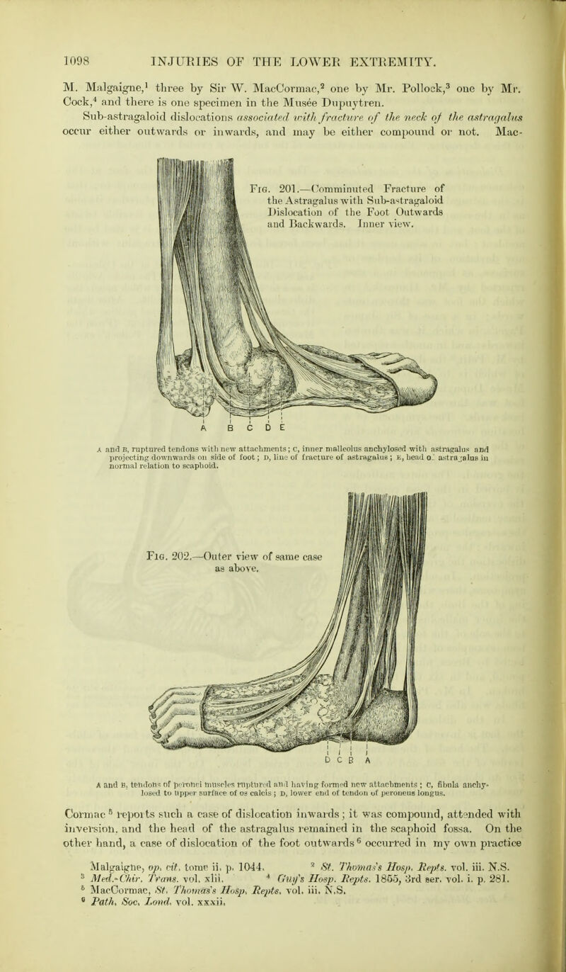 M. Malgaigne,1 three by Sir W. MacCormac,2 one by Mr. Pollock,3 one by Mr. Cock,4 and there is one specimen in the Musee Dupuytren. Sub-astragaloid dislocations associated with fracture of the neck of the astragalus occur either outwards or inwards, .and may be either compound or not. Mac- A B C D E A and n, ruptured tendons with new attachments; c, inner malleolus ancuyloscd with astragalus and projecting downwards on side of foot; D, line of fracture of astragalus ; t, head o. astrajaluB in normal relation to scaphoid. A and B. tendons nf perohei mnscles raptured and having formed new attachments ; c, fibula anchy- loscd to Upper surface of os calcis ; d, lower end of tendon of peroneus lougus. Cormac 6 reports such a case of dislocation inwards; it was compound, attended with inversion, and the head of the astragalus remained in the scaphoid fossa. On the other hand, a case of dislocation of the foot outwards6 occurred in my own practice Malgaighe, op, cit, tome ii. p. 1044. 2 St. ThoTnas't Hasp. Repts. vol. iii. N.S. 3 MedrChir, Tram. vol. xlil. 4 Guy's Hosp. Repts. 1855, 3rd ser. vol. i. p. 281. 6 MacCormac, <SY. Thomas's Hasp, Repts, vol. iii. N.S. 6 Path, Soc, Lond, vol. xxxii,
