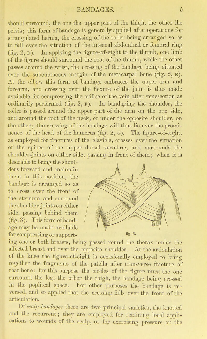 should surround, tJie one the upper part of the thigh, the other the pelvis; this form of bandage is generally apphed after operations for strangulated hernia, the crossing of the roller being arranged so as to fall over the situation of the internal abdominal or femoral ring (fig. 2, d). In applying the figure-of-eight to the thumb, one limb of the figure should sm-round the root of the thumb, while the other passes ai'ound the wrist, the crossing of the bandage being situated over the subcutaneous margin of the metacarpal bone (fig. 2, e). At the elbow this form of bandage embraces the upper arm and forearm, and crossing over the flexure of the joint is thus made available for compressing the orifice of the vein after venesection as ordmai'ily performed (fig, 2, f). In bandagmg the shoulder, the roller is passed around the upper part of the arm on the one side, and ai-ound the root of the neck, or under the opposite shoulder, on the other; the crossing of the bandage will thus lie over the promi- nence of the head of the humerus (fig. 2, g). The figm'e-of-eight, as employed for fractures of the clavicle, crosses over the situation of the spines of the upper dorsal vertebraa, and sm'rounds the shoulder-joints on either side, passmg in ft-ont of them; when it is desu-able to brine: the shoul- j A them in this position, the ' bandage is arranged so as to cross over the ft'ont of the sternum and surround the shoulder-joints on either side, passing behind them (fig, 3). This form of band- age may be made available for compressing or suppoi't- ^■ ing one or both breasts, being passed round the thorax under the affected breast and over the opposite shoulder. At the ai-ticulation of the knee the figure-of-eight is occasionally employed to bring together the fragments of the patella after transverse fi-acture of that bone; for this purpose the circles of the figure must the one surround the leg, the other the thigh, the bandage being crossed in the popliteal space. For other pm-poses the bandage is re- versed, and so applied that the crossing falls over the fi-ont of the articulation. Of scaljy-handar/es there are two principal varieties, the knotted and the recurrent; tliey arc employed for retaining local appli- cations to wounds of the scalp, or for exercising pressure on the