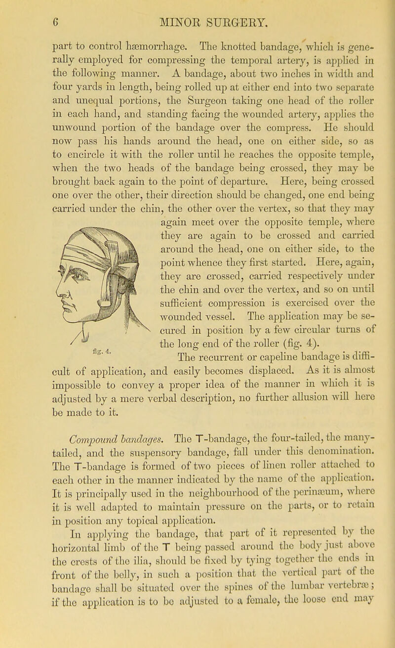 part to control hajmoiTliage. The knotted bandage, wliicli is gene- rally employed for compressing the temporal artery, is applied in the following manner. A bandage, about two inches in width and four yards in length, being rolled up at either end into two separate and unequal j)ortions, the Surgeon taking one head of the roller in each hand, and standing facing the wounded ai'teiy, applies the unwomid j)ortion of the bandage over the compress. He should now pass his hands around the head, one on either side, so as to encircle it with the roller until he reaches the opposite temple, when the two heads of the bandage being crossed, they may be brouglit back again to the jDoint of departure. Here, being crossed one over the other, their direction should be changed, one end being cai'ried under the chin, the other over the vertex, so that they may again meet over the opposite temple, where they are again to be crossed and carried around the head, one on either side, to the point whence they fii'st started. Here, again, they are crossed, carried respectively under the chin and over the vertex, and so on mitil sufficient compression is exercised over the wounded vessel. The application may be se- cm-ed in position by a few circulai turns of the long end of the roller (fig. 4). The recurrent or capeline bandage is diffi- cult of application, and easily becomes displaced. As it is almost impossible to convey a proper idea of the manner m wliich it is adjusted by a mere verbal description, no fm-ther allusion will here be made to it. Comjjound landages. Tlie T-bandage, the fom'-tailcd, the many- tailed, and the suspensory bandage, fall under this denomination. The T-bandage is formed of two pieces of linen roller attached to each other in the manner indicated by the name of the application. It is principally used in the neighbourhood of the perina3um, where it is well adapted to maintain pressure on the parts, or to retain in position any topical application. In applying the bandage, that part of it represented by the horizontal limb of the T being passed ai'ound the body just above the crests of the ilia, should be fixed by tying together the ends in front of the belly, in such a position that the vertical part of the bandage shall bo situated over tlio spines of the lumbal- vertebrae; if the application is to bo adjusted to a female, the loose end may