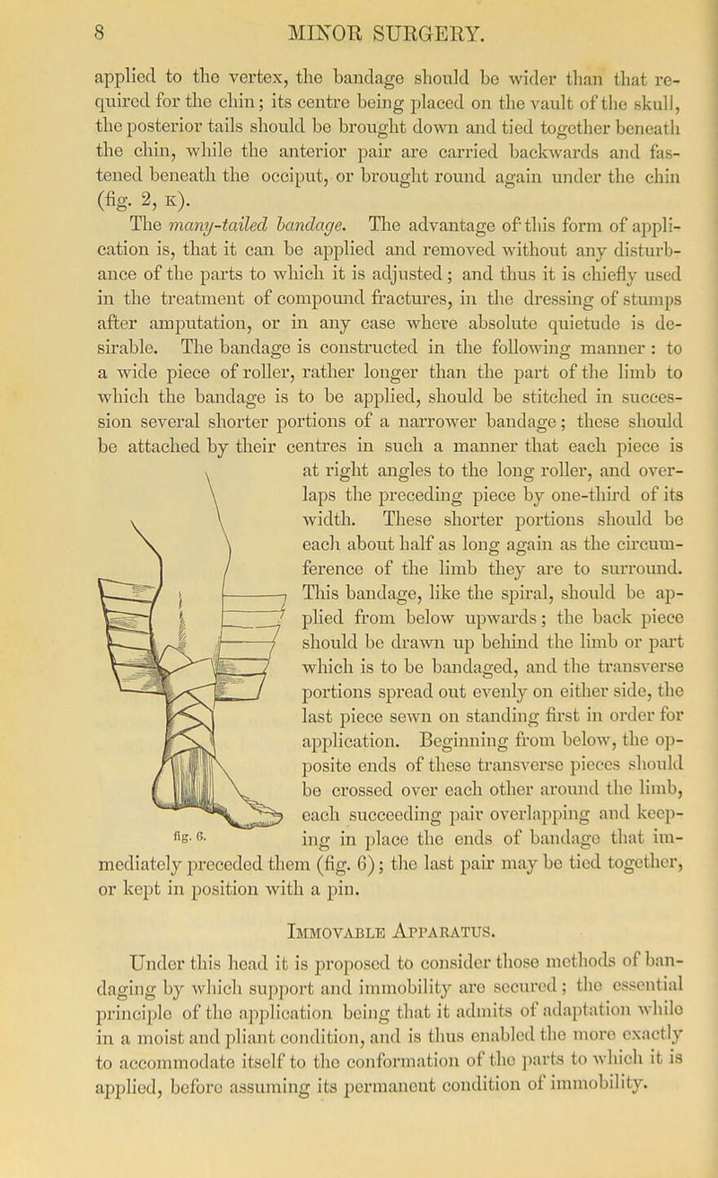 applied to the vertex, the bandage should be wider than that re- quired for the chin; its centre being placed on the vault of the skull, the posterior tails should be brought down and tied together beneath the chin, while the anterior pair are carried backwards and fas- tened beneath the occiput, or brought round again under the chin (fig. 2, K). The many-tailed bandage. Tlae advantage of this form of appli- cation is, that it can be applied and removed without any disturb- ance of the parts to which it is adjusted; and thus it is chiefly used in the treatment of compomid fractm^es, in the dressing of stmnps after amputation, or in any case where absolute quietude is de- su^able. The bandage is constructed in the following manner : to a wide piece of roller, rather longer than the part of the limb to which the bandage is to be applied, should be stitched in succes- sion several shorter portions of a narrower bandage; these should be attached by their centres in such a manner that each piece is at right angles to the long roller, and over- laps the preceding piece by one-thhd of its width. These shorter portions should be each about half as long again as the circum- ference of the limb they are to sm-round. This bandage, like the spiral, should be ap- phed from below upwards; the back piece should be drawn up behind the limb or part which is to be bandaged, and the transverse portions spread out evenly on either side, the last piece sewn on standing first in order for application. Beginning from below, the op- posite ends of these transverse pieces should be crossed over each other around the limb, each succeeding pair overlapping and keep- ^'^e- f'- ing in place the ends of bandage that im- mediately preceded them (fig. 6); the last pau' may be tied together, or kept in position with a pin. Immovable Apparatus. Under this head it is proposed to consider those methods of ban- daging by which support and immobility are secured ; the essential principle of the application being that it admits of adaptation while in a moist and pliant condition, and is thus enabled the more exactly to accommodate itself to the conformation of the parts to which it is applied, before assuming its permanent condition of immobility.