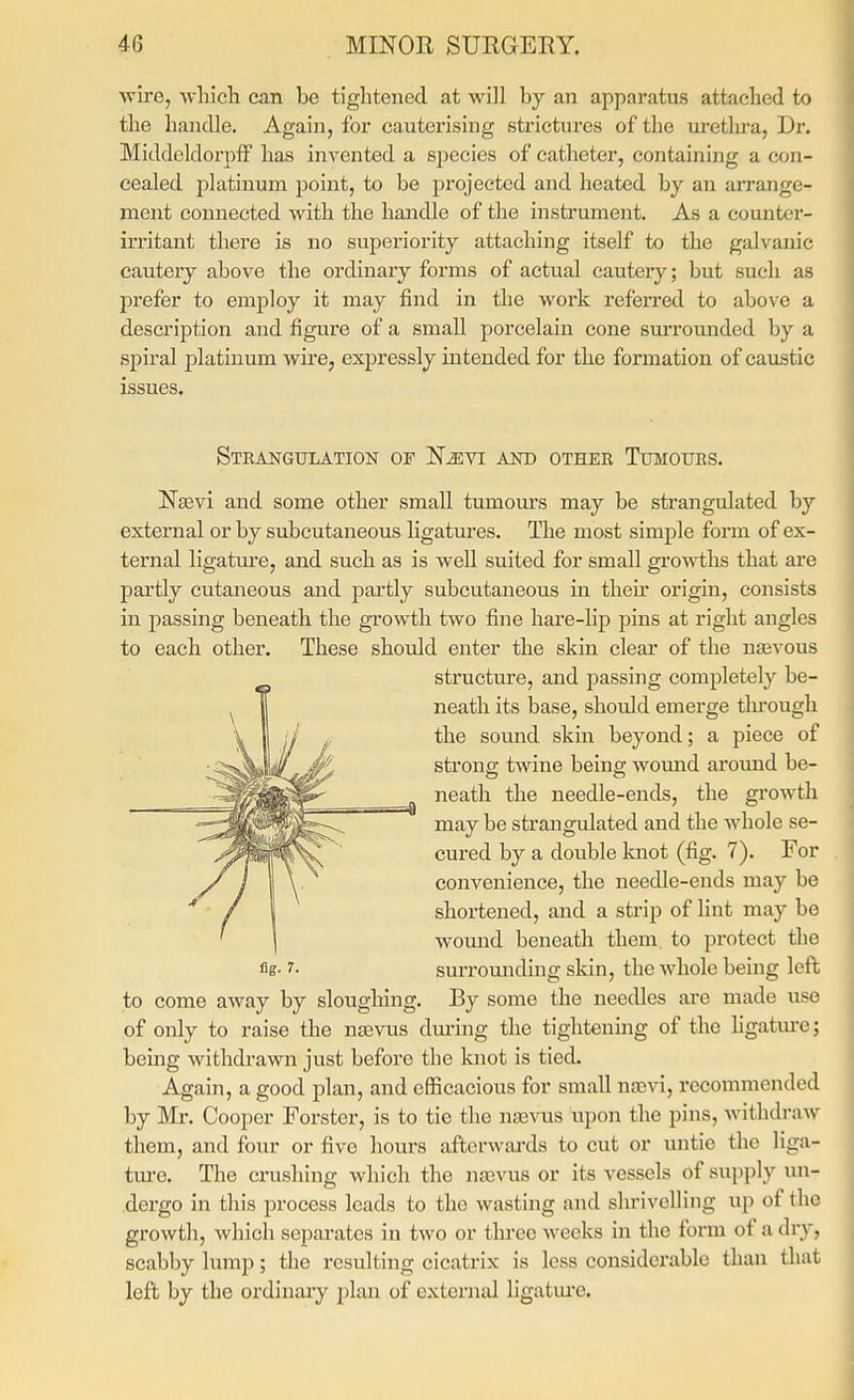 wire, which can be tightened at will by an apparatus attached to the handle. Again, for cauterising strictures of the ui-etlira. Dr. Middeldorpff has invented a species of catheter, containing a con- cealed platinum point, to be projected and heated by an arrange- ment connected with the handle of the instrument. As a counter- irritant there is no superiority attaching itself to the galvanic cautery above the ordinary forms of actual cautery; but such as prefer to employ it may find in the work referred to above a description and figure of a small porcelain cone surrounded by a spiral platinum wire, expressly intended for the formation of caiLstic issues. Steangulation of N^vi and other Tumours. Nsevi and some other small tumom's may be strangulated by external or by subcutaneous hgatures. The most simple form of ex- ternal ligature, and such as is well suited for small growths that are partly cutaneous and partly subcutaneous in then origin, consists in passing beneath the growth two fine hare-lip pins at right angles to each other. These should enter the skin clear of the na^vous structure, and passing completely be- neath its base, should emerge tlnough the somid skin beyond; a piece of strong twine being womid aromid be- neath the needle-ends, the growth may be strangulated and the whole se- cured by a double Icnot (fig. 7). For convenience, the needle-ends may be shortened, and a strip of lint may be womid beneath them to protect the fig- 7- surromiding skin, the whole being left to come away by sloughing. By some the needles are made use of only to raise the nasvus dm'ing the tightenmg of the hgatm-e; being withdrawn just before the knot is tied. Again, a good plan, and efficacious for small njEvi, recommended by Mr. Cooper Forstcr, is to tie the n£e^a^s upon the pins, withdraw them, and four or five hours afterwai'ds to cut or untie the liga- tm-e. The crushing which the nrevus or its vessels of supply un- dergo in this process leads to the wasting and shrivelling up of the growth, which separates in two or three weeks in the form of a dry, scabby lump; the resulting cicatrix is less considerable than that left by the ordinaiy jjhm of external ligatui'e.