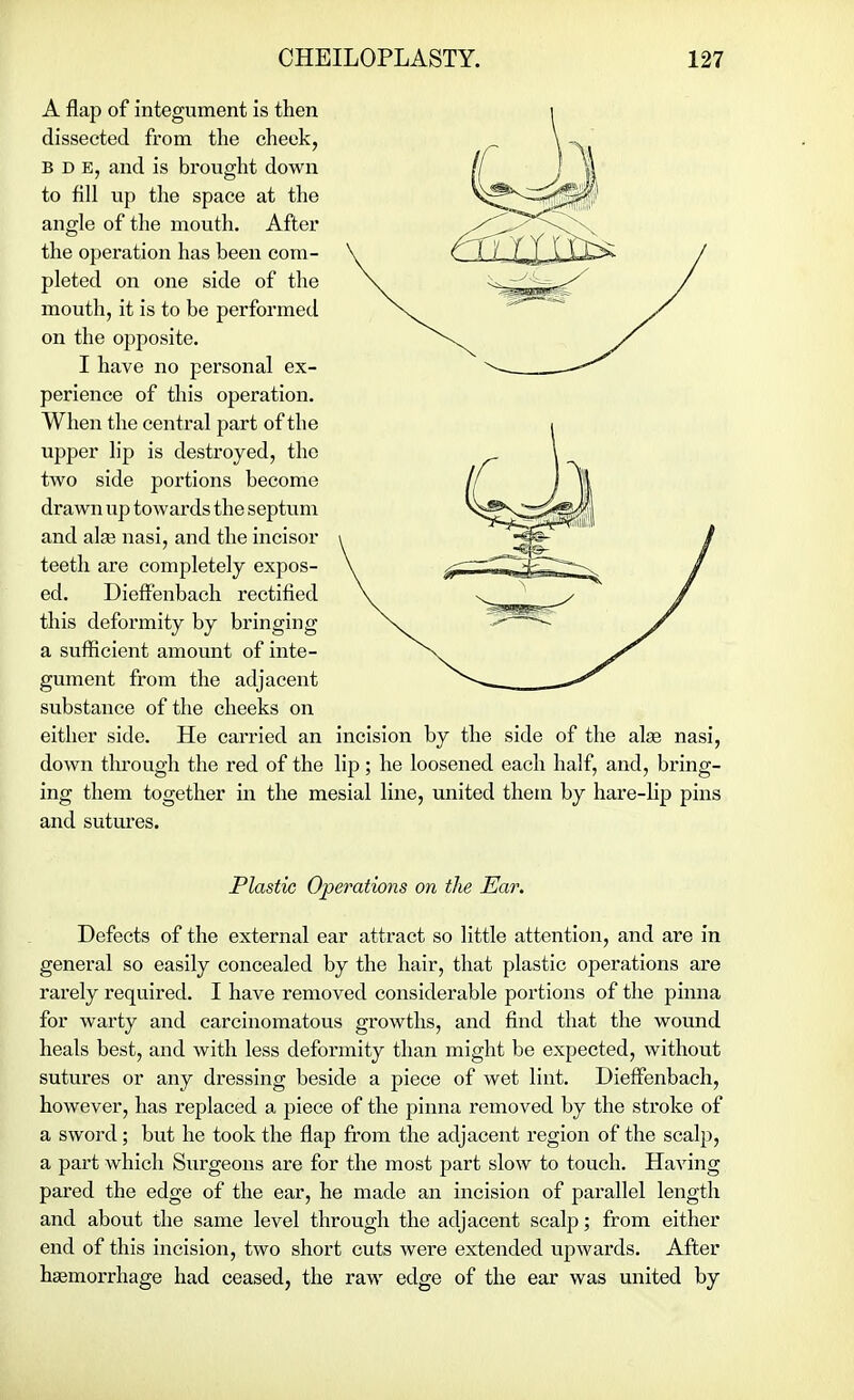 A flap of integument is then dissected from the cheek, B D E, and is brought down to fill up the space at the angle of the mouth. After the operation has been com- pleted on one side of the mouth, it is to be performed on the opposite. I have no personal ex- perience of this operation. When the central part of the upper lip is destroyed, the two side portions become drawn up towards the septum and ala? nasi, and the incisor teeth are completely expos- ed. Dieffenbach rectified this deformity by bringing a sufficient amount of inte- gument from the adjacent substance of the cheeks on either side. He carried an incision by the side of the alse nasi, down through the red of the lip; he loosened each half, and, bring- ing them together in the mesial line, united them by hare-lip pins and sutures. Plastic Operations on the Ear. Defects of the external ear attract so little attention, and are in general so easily concealed by the hair, that plastic operations are rarely required. I have removed considerable portions of the pinna for warty and carcinomatous growths, and find that the wound heals best, and with less deformity than might be expected, without sutures or any dressing beside a piece of wet lint. Dieffenbach, however, has replaced a piece of the pinna removed by the stroke of a sword; but he took the flap from the adjacent region of the scalp, a part which Surgeons are for the most part slow to touch. Having pared the edge of the ear, he made an incision of parallel length and about the same level through the adjacent scalp; from either end of this incision, two short cuts were extended upwards. After ha3morrhage had ceased, the raw edge of the ear was united by