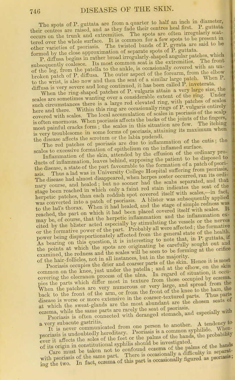 The spots of P. guttata are from a quarter to ^lf an inch * diameter their centres are raised, and as they fade their centres heal first. P. guttata occurs on the trunk and extremities. The spots are often irregularly scat- W over ttie whole surface. It is common for a few spots to be present in other varieties of psoriasis. The twisted bands £^8^™ ^ * b° formed bv the close approximation of separate spots oi I. guttata. & P diffusa begins father broad irregularly-shaped angnla* patcheswhkl subsequently coalesce. Its most common seat is the extremities. The front S the kg &om the patella to the ankle, is occasionally covered with an un- broken patch of P. diffusa. The outer aspect of the forearm, from the elbow to the wrist is also now and then the seat of a similar large patch, men F. muLTs ve'ry severe and long continued, it has been called P. mveterata. When tU ring-shaped patches of P. vulgaris attain a very large size he scaled are sometimes wanting over a considerable extent of the rmg. Under such circumstances there is a large red elevated ^^^^^^ here and there Within this ring are occasionally rings of P. vulgaris entirely covered wfth scales. The local accumulation of scales in psoriasis of the scalp SXMormons. When psoriasis affects the backs of the pmts of!th^ngers rnnst nainful cracks form ; the scales m this situation are few. Ine itcnin - some forms of psoriasis, attaining its maximum when the disease affects the scrotum or the labia pudendi. The red patches of psoriasis are due to inflammation of the cutis, tne scales to excessive formation of epithelium on the inflamed Inflammation of the skin, attended by the effusion of the ordmary pro ducts of inflammation, leaves behind, supposing the patient to be disposea to Ssl a state of the part favouxable to g^^^^SS asis Thus a lad was m University College Hospital surrering u^uii or the formative power of the part. J™^.ge^Sffi of the health. Sn?^ rf the hah-follicles, not in all instances, but m the . Psoriasis occupies the drier and coarser parts of the skm J±en common on the knee, just under the^patella ^^^^ it 0ccu- covering the olecranon process of the ulna ^ ^°^upied by eczema, pies the parts which differ most m texture from^ ^ the When the patches are very numerous or ^^g^Xe ham, the back to the front of the arm, or from the front of the knee to disease is worse or more extensive in the coarse \Jts of at which the sweat-glands are the mos abnndaat^ejhe chosen «ind especially with aTnevf cheated from one person to ^-±£^8,*