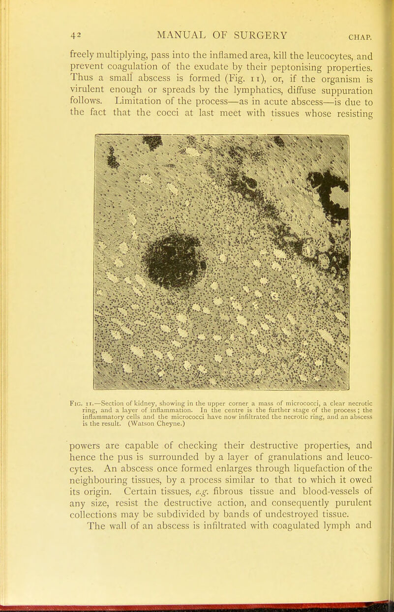 freely multiplying, pass into the inflamed area, kill the leucocytes, and prevent coagulation of the exudate by their peptonising properties. Thus a small abscess is formed (Fig. ii), or, if the organism is virulent enough or spreads by the lymphatics, diffuse suppuration follows. Limitation of the process—as in acute abscess—is due to the fact that the cocci at last meet with tissues whose resisting Fig. II. — Scctiuii ul kidney, showing in tin; Lipper corner a mass of micrococci, a clear necrotic ring, and a layer of inflammation. In the centre is the furtlier stage of the process; the inflammatory cells and the micrococci have now infiltrated the necrotic ring, and an ahscess is the result. (Watson Cheyne.) powers are capable of checking their destructive properties, and hence the pus is surrounded by a layer of granulations and leuco- cytes. An abscess once formed enlarges through liquefaction of the neighbouring tissues, by a process similar to that to which it owed its origin. Certain tissues, e.g. fibrous tissue and blood-vessels of any size, resist the destructive action, and consequently purulent collections may be subdivided by bands of undcstroyed tissue. The wall of an abscess is infiltrated with coagulated lymph and