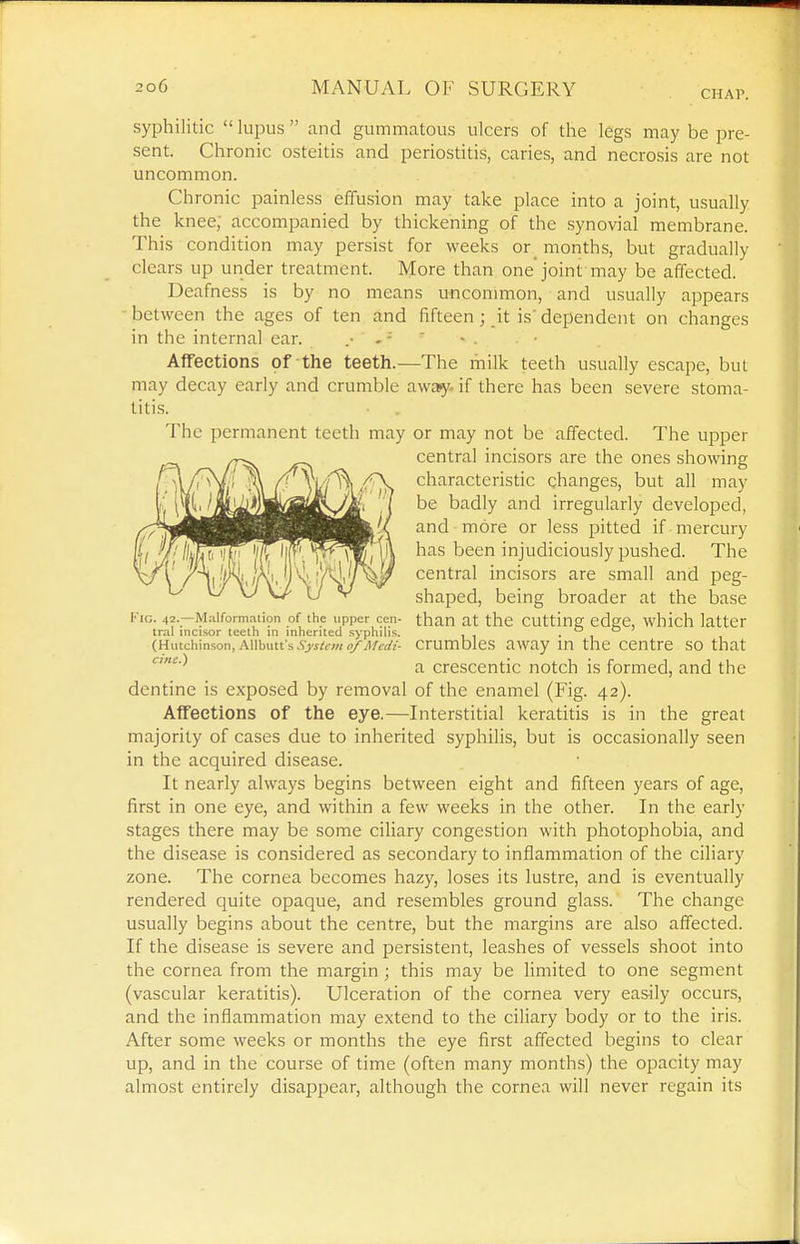 CHAP. syphilitic  lupus  and gummatous ulcers of the legs may be pre- sent. Chronic osteitis and periostitis, caries, and necrosis are not uncommon. Chronic painless effusion may take place into a joint, usually the knee; accompanied by thickening of the synovial membrane. This condition may persist for weeks or_ months, but gradually clears up under treatment. More than one'joint may be affected. Deafness is by no means uncommon, and usually appears between the ages of ten and fifteen ; it is'dependent on changes in the internal ear. .• - - ' Affections of the teeth.—The milk teeth usually escape, bul may decay early and crumble away, if there has been severe stoma- titi.s. The permanent teeth may or may not be affected. The upper central incisors are the ones showing characteristic changes, but all may be badly and irregularly developed, and more or less pitted if mercury has been injudiciously pushed. The central incisors are small and peg- shaped, being broader at the base Fig. 42.-Maiform.iiion of the upper cen- than at the Cutting edge, which latter tral incisor teeth in inherited syphihs. , , . , ° (Hutchinson, Aiibutt'.s.s>j/(7«<yii/£n'/- crumblcs away m the centre so that ''^ a crescentic notch is formed, and the dentine is exposed by removal of the enamel (Fig. 42). Affections of the eye.—Interstitial keratitis is in the great majority of cases due to inherited syphilis, but is occasionally seen in the acquired disease. It nearly always begins between eight and fifteen years of age, first in one eye, and within a few weeks in the other. In the early stages there may be some ciliary congestion with photophobia, and the disease is considered as secondary to inflammation of the ciliary zone. The cornea becomes hazy, loses its lustre, and is eventually rendered quite opaque, and resembles ground glass. The change usually begins about the centre, but the margins are also affected. If the disease is severe and persistent, leashes of vessels shoot into the cornea from the margin ; this may be limited to one segment (vascular keratitis). Ulceration of the cornea very easily occurs, and the inflammation may extend to the ciliary body or to the iris. After some weeks or months the eye first affected begins to clear up, and in the course of time (often many months) the opacity may almost entirely disappear, although the cornea will never regain its