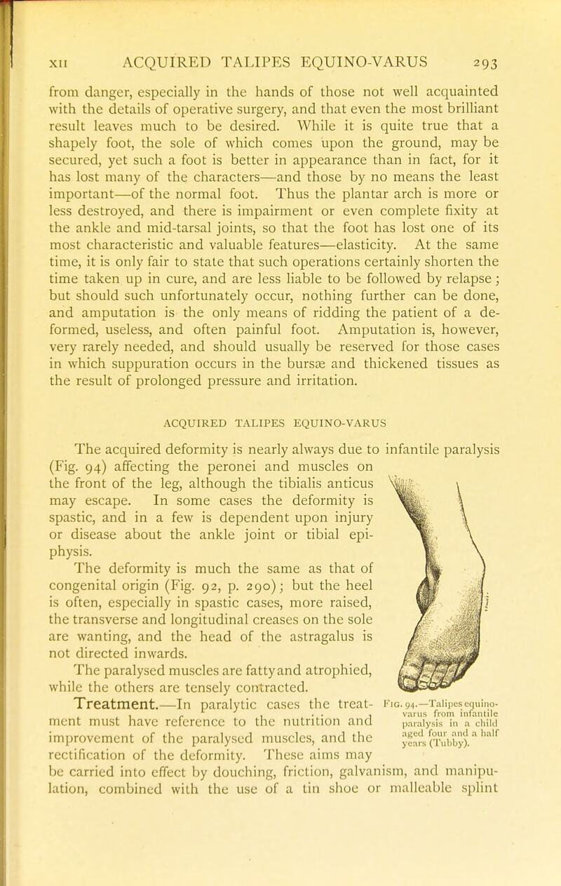 from danger, especially in the hands of those not well acquainted with the details of operative surgery, and that even the most brilliant result leaves much to be desired. While it is quite true that a shapely foot, the sole of which comes upon the ground, may be secured, yet such a foot is better in appearance than in fact, for it has lost many of the characters—and those by no means the least important—of the normal foot. Thus the plantar arch is more or less destroyed, and there is impairment or even complete fixity at the ankle and mid-tarsal joints, so that the foot has lost one of its most characteristic and valuable features—elasticity. At the same time, it is only fair to state that such operations certainly shorten the time taken up in cure, and are less liable to be followed by relapse; but should such unfortunately occur, nothing further can be done, and amputation is the only means of ridding the patient of a de- formed, useless, and often painful foot. Amputation is, however, very rarely needed, and should usually be reserved for those cases in which suppuration occurs in the burste and thickened tissues as the result of prolonged pressure and irritation. ACQUIRED TALIPES EQUINO-VARUS The acquired deformity is nearly always due to infantile paralysis (Fig. 94) affecting the peronei and muscles on the front of the leg, although the tibialis anticus may escape. In some cases the deformity is spastic, and in a few is dependent upon injury or disease about the ankle joint or tibial epi- physis. The deformity is much the same as that of congenital origin (Fig. 92, p. 290); but the heel is often, especially in spastic cases, more raised, the transverse and longitudinal creases on the sole are wanting, and the head of the astragalus is not directed inwards. The paralysed muscles are fatty and atrophied, while the others are tensely contracted. Treatment.—In paralytic cases the treat- ment must have reference to the nutrition and improvement of the paralysed muscles, and the rectification of the deformity. These aims may be carried into effect by douching, friction, galvanism, and manipu- lation, combined with the use of a tin shoe or malleable splint KiG.94. Talipes cciuiiio- variis from inrniuile paralysis in a child aged four and .a half years (Tidiby).